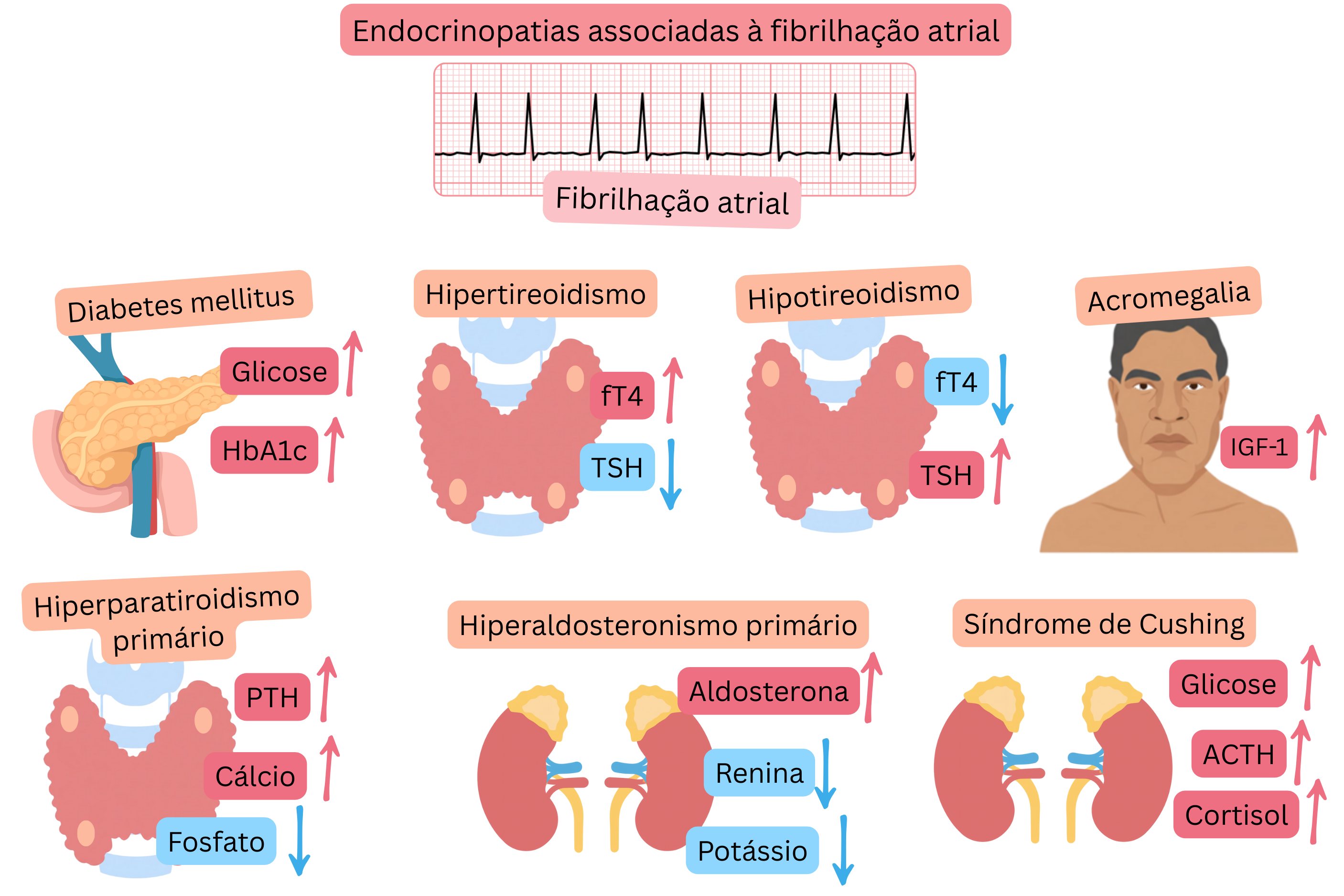 Infográfico que ilustra endocrinopatias associadas à fibrilação atrial, incluindo diabetes mellitus, hipertireoidismo, hipotireoidismo, acromegalia, hiperparatireoidismo primário, hiperaldosteronismo primário e síndrome de Cushing, com alterações hormonais e metabólicas típicas e registo ECG de fibrilação atrial.