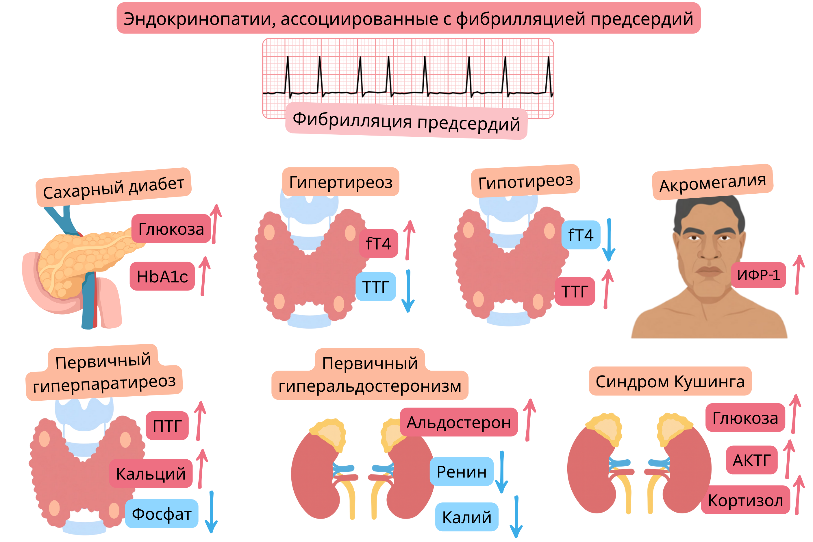 Инфографика, демонстрирующая эндокринопатии, ассоциированные с фибрилляцией предсердий, включая сахарный диабет, гипертиреоз, гипотиреоз, акромегалию, первичный гиперпаратиреоз, первичный гиперальдостеронизм и синдром Кушинга, с типичными гормональными и метаболическими изменениями и ЭКГ-документацией фибрилляции предсердий.