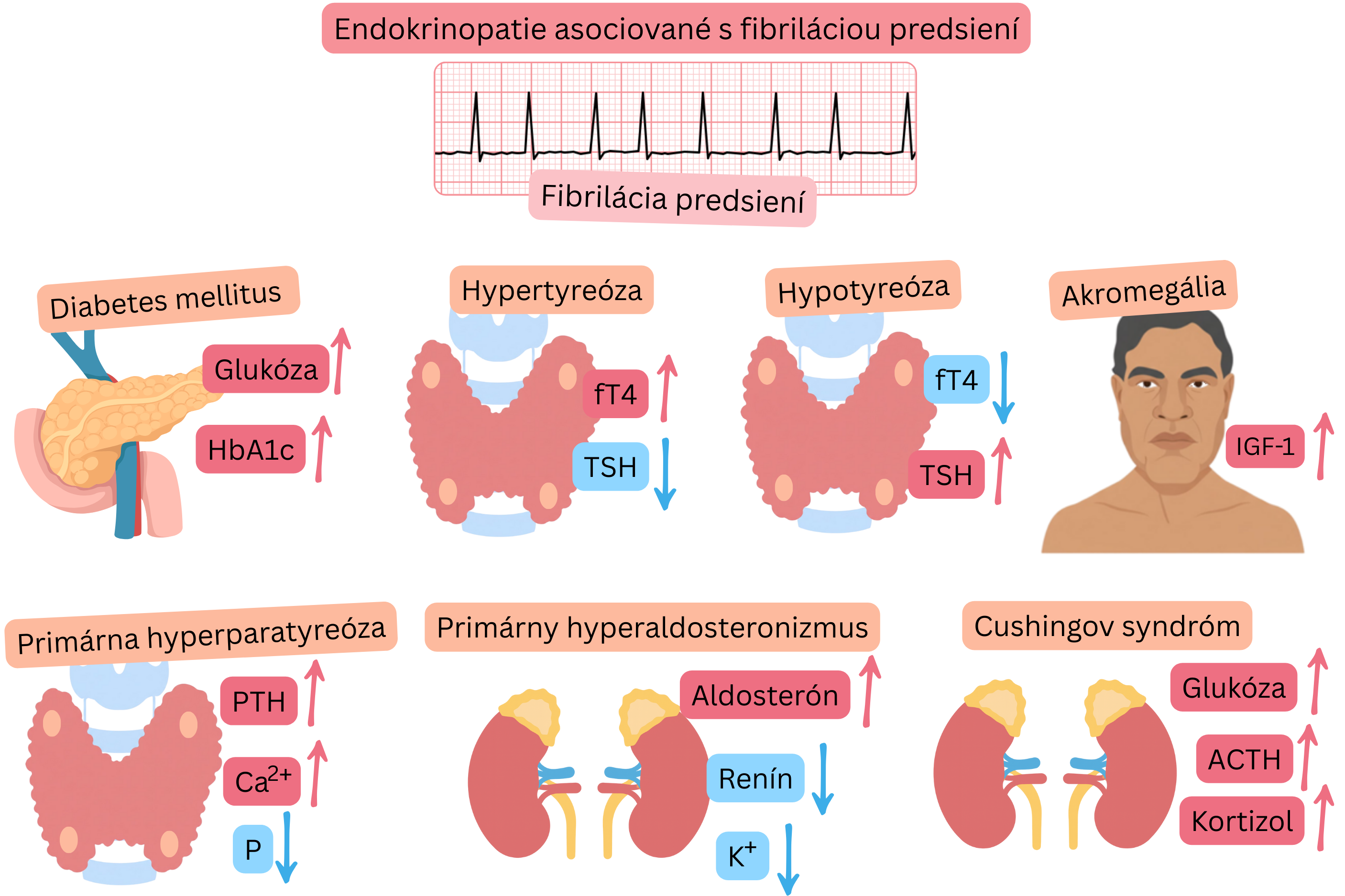 Infografika znázorňujúca endokrinopatie asociované s fibriláciou predsiení vrátane diabetu mellitus, hypertyreózy, hypotyreózy, akromegálie, primárnej hyperparatyreózy, primárneho hyperaldosteronizmu a Cushingovho syndrómu s typickými hormonálnymi a metabolickými zmenami a EKG záznamom fibrilácie predsiení.