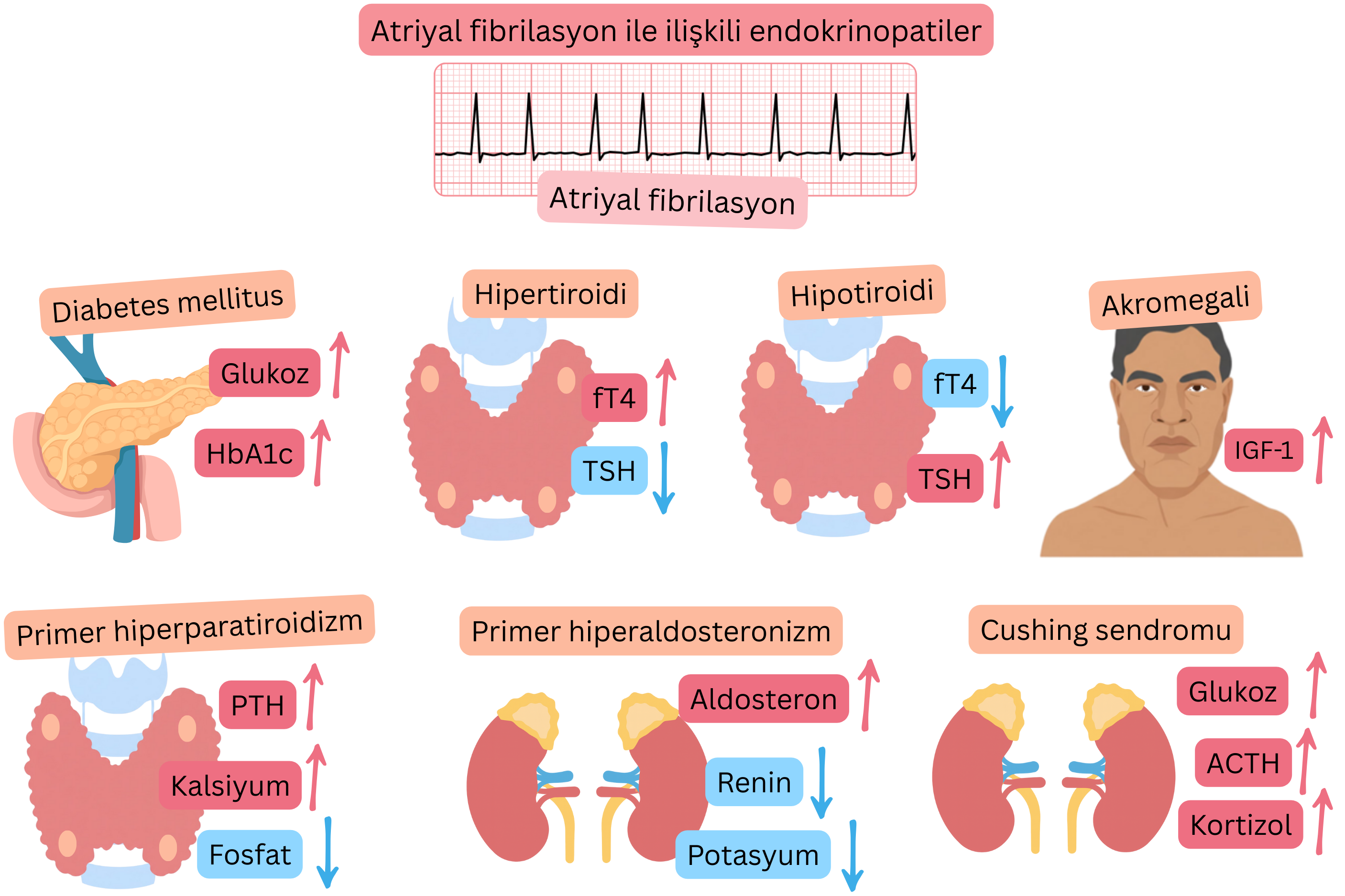 Atriyal fibrilasyonla ilişkili endokrinopatileri; diabetes mellitus, hipertiroidi, hipotiroidi, akromegali, primer hiperparatiroidizm, primer hiperaldosteronizm ve Cushing sendromunu, tipik hormonal ve metabolik değişiklikler ile atriyal fibrilasyonun EKG kaydı eşliğinde gösteren infografik.