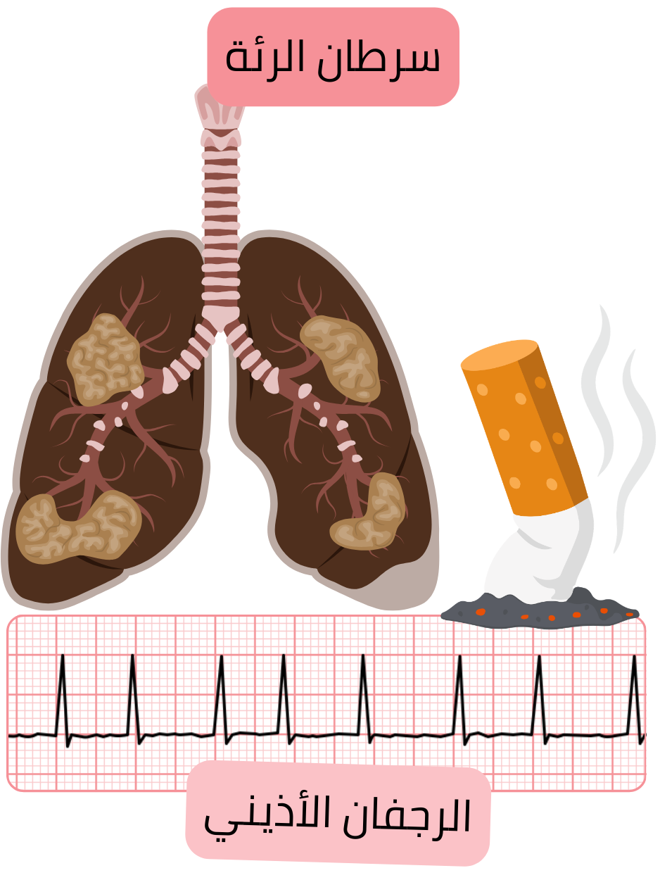 رسم توضيحي يبيّن سرطان الرئة كمرض مرافق مرتبط بالرجفان الأذيني، مع إصابة رئوية مرضية وتوثيق تخطيط القلب الكهربائي لاضطراب النظم.
