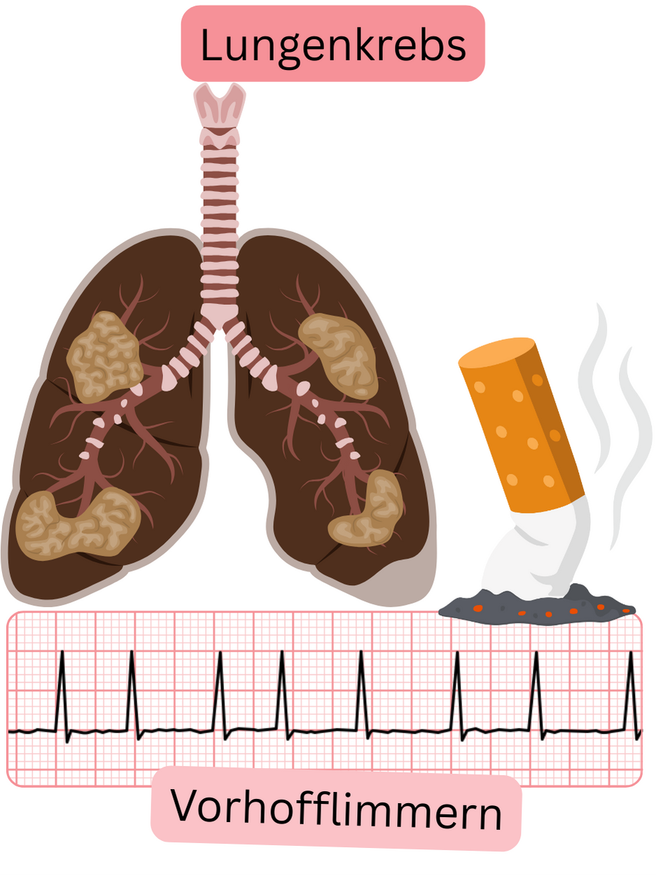 Abbildung, die Lungenkrebs als mit Vorhofflimmern assoziierte Komorbidität mit pathologischer Lungenbeteiligung und dokumentierter EKG-Aufzeichnung der Arrhythmie darstellt.