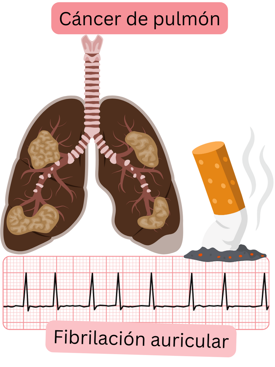 Ilustración que muestra el cáncer de pulmón como una comorbilidad asociada a la fibrilación auricular, con afectación pulmonar patológica y registro ECG documentado de la arritmia.