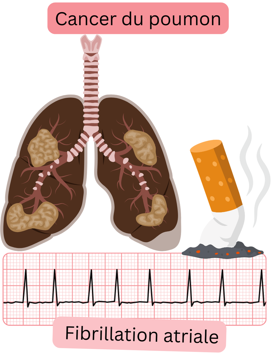 Illustration représentant le cancer du poumon comme une comorbidité associée à la fibrillation atriale, avec atteinte pulmonaire pathologique et tracé ECG documenté de l’arythmie.