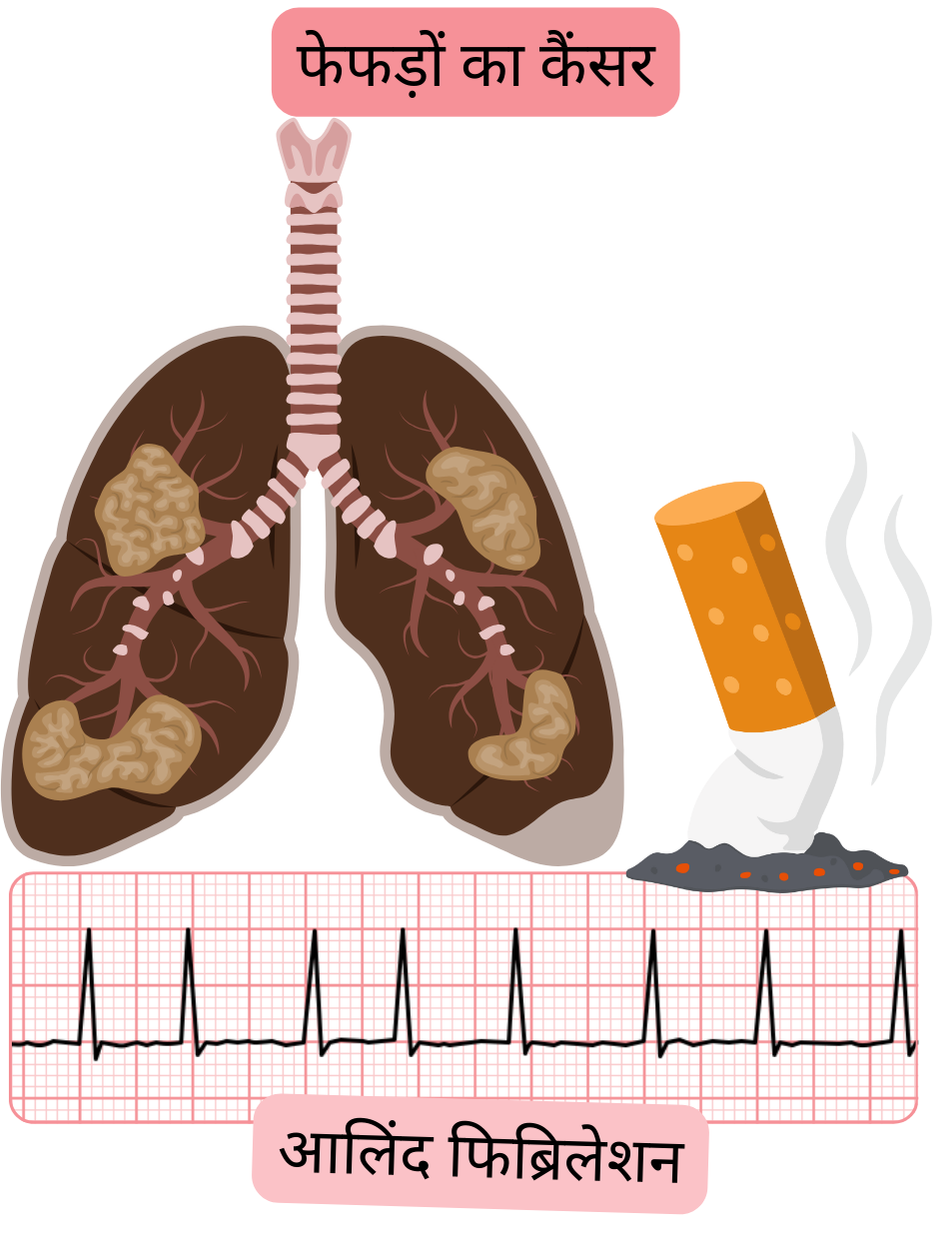 चित्र में फेफड़ों के कैंसर को एट्रियल फिब्रिलेशन से जुड़ी सह-रोग अवस्था के रूप में दर्शाया गया है, जिसमें फेफड़ों की रोगात्मक संलिप्तता और अतालता का प्रलेखित ईसीजी रिकॉर्ड शामिल है।
