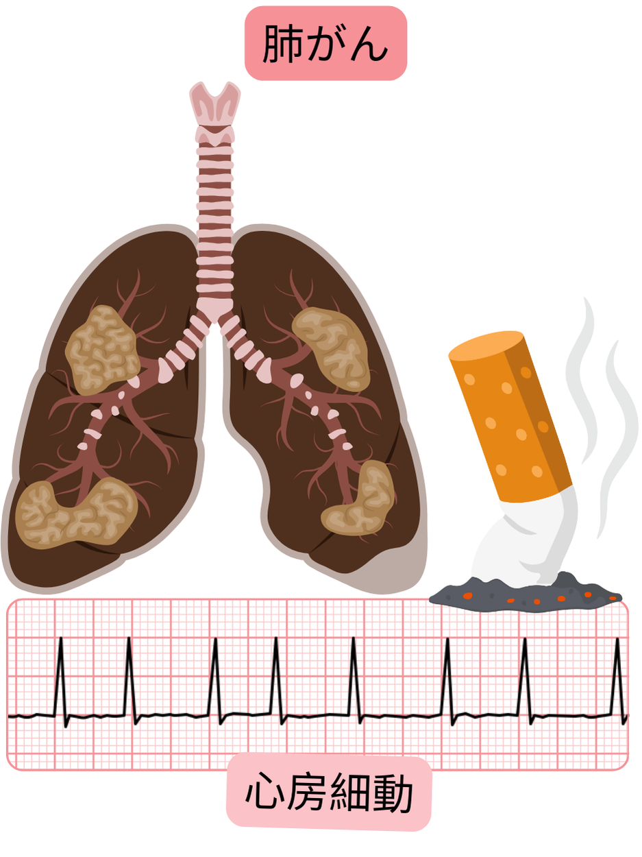 肺癌を心房細動に関連する併存疾患として示し、病理学的肺病変と不整脈の心電図記録を含む図。