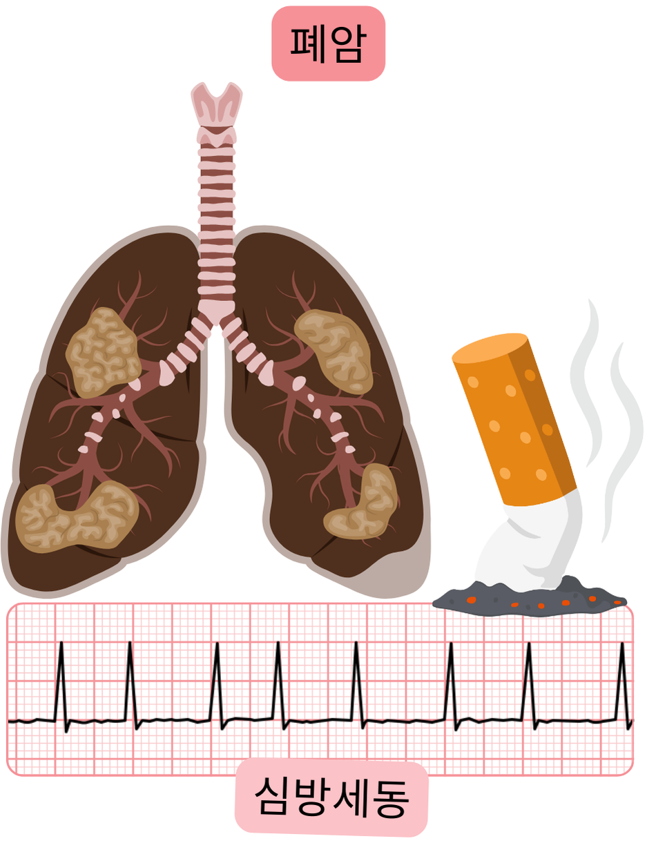 폐암을 심방세동과 연관된 동반 질환으로 제시하며, 병리적 폐 침범과 부정맥의 심전도 기록을 포함한 일러스트.