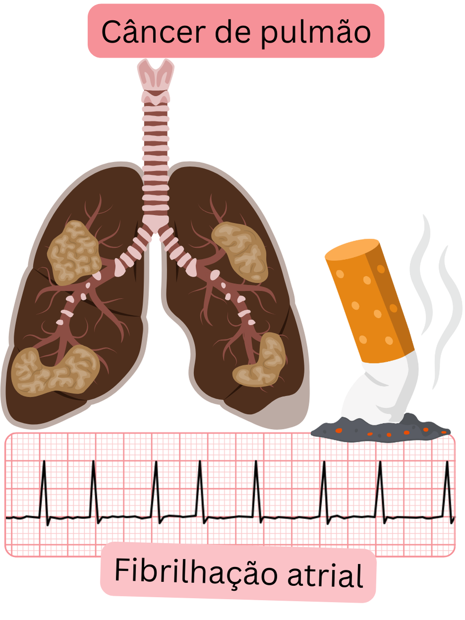 Ilustração que demonstra o cancro do pulmão como comorbilidade associada à fibrilação atrial, com envolvimento pulmonar patológico e registo ECG documentado da arritmia.