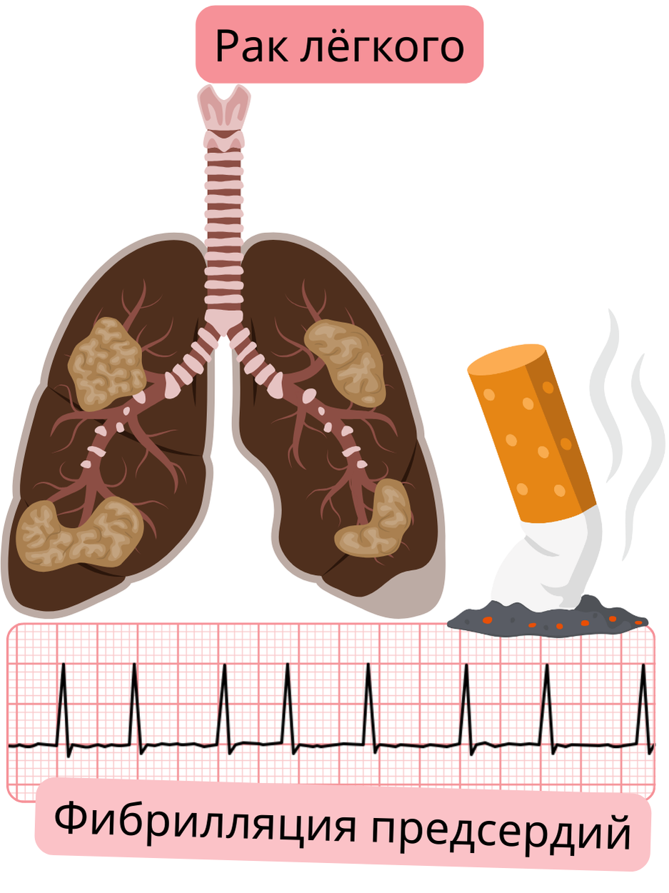 Иллюстрация, показывающая рак лёгкого как коморбидное состояние, ассоциированное с фибрилляцией предсердий, с патологическим поражением лёгких и документированной ЭКГ-записью аритмии.