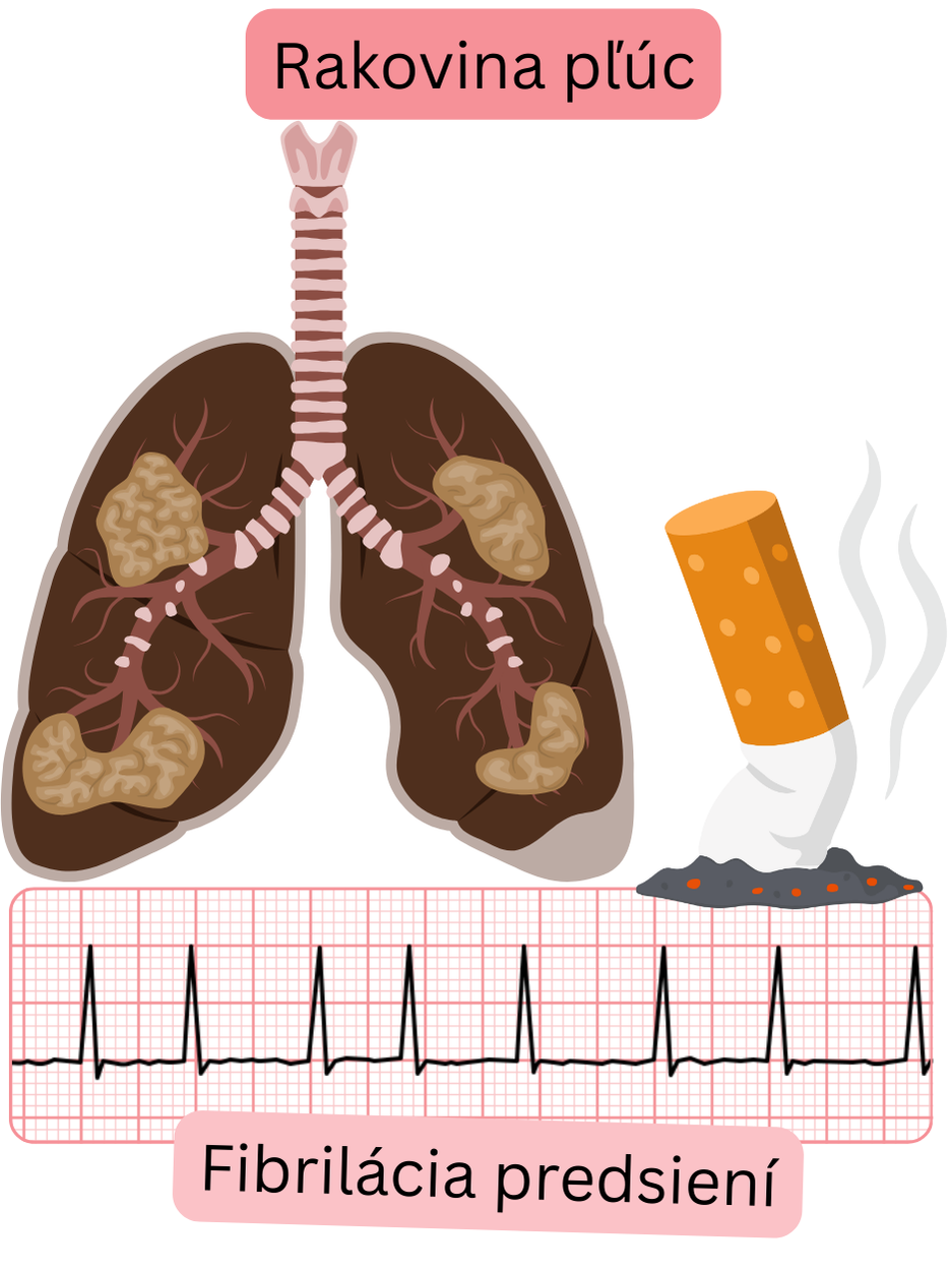 Ilustrácia znázorňujúca rakovinu pľúc ako komorbiditu asociovanú s fibriláciou predsiení s patologickým postihnutím pľúc a dokumentovaným EKG záznamom arytmie.