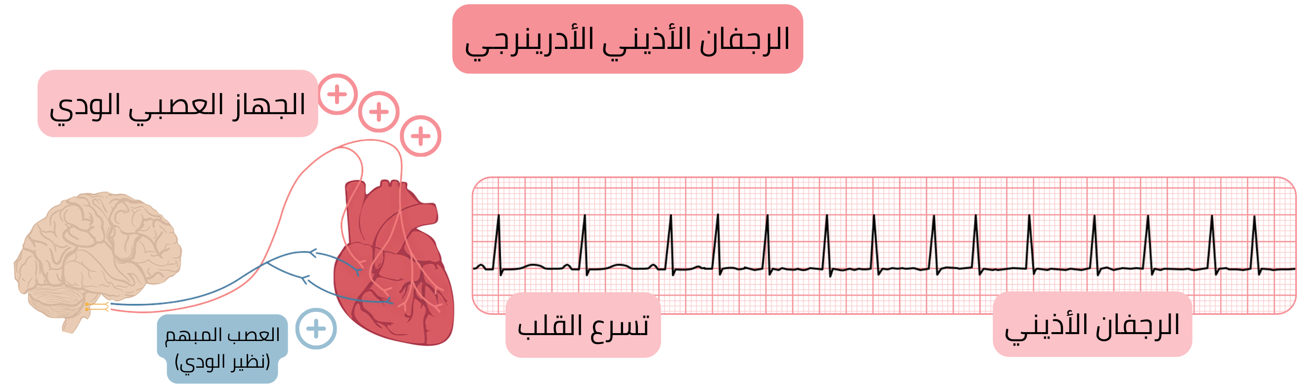رسم توضيحي يبيّن الرجفان الأذيني الأدرينالي الناتج عن زيادة نشاط الجهاز الودي مع تسرّع القلب والانتقال إلى الرجفان الأذيني على تخطيط القلب الكهربائي.