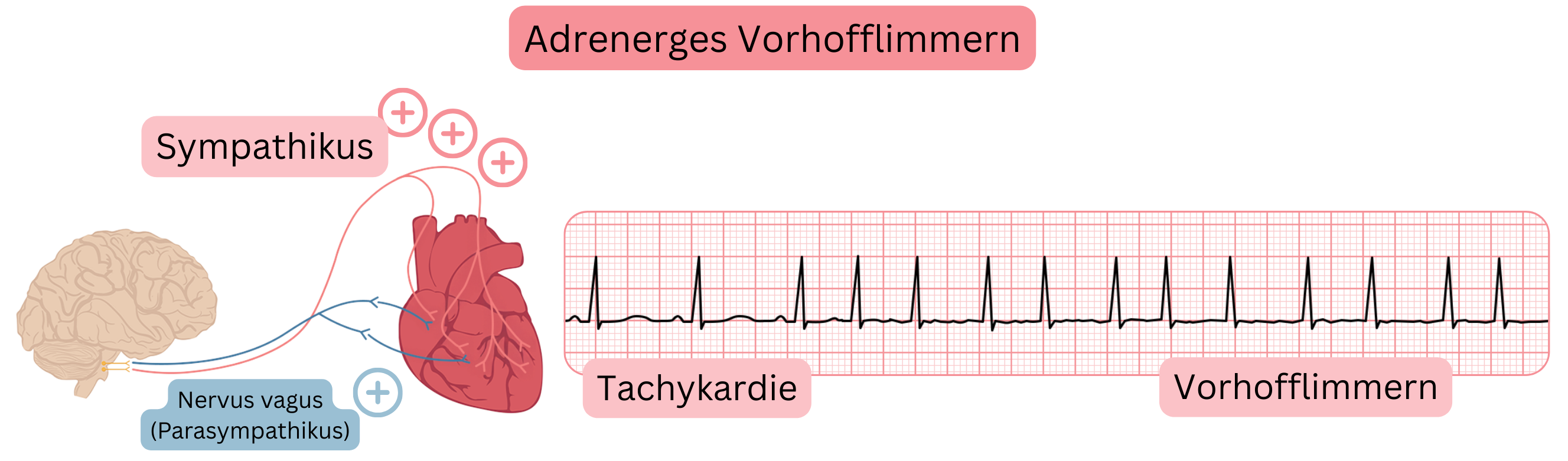Abbildung, die adrenerges Vorhofflimmern infolge erhöhter sympathischer Aktivität mit Tachykardie und Übergang in Vorhofflimmern im EKG darstellt.