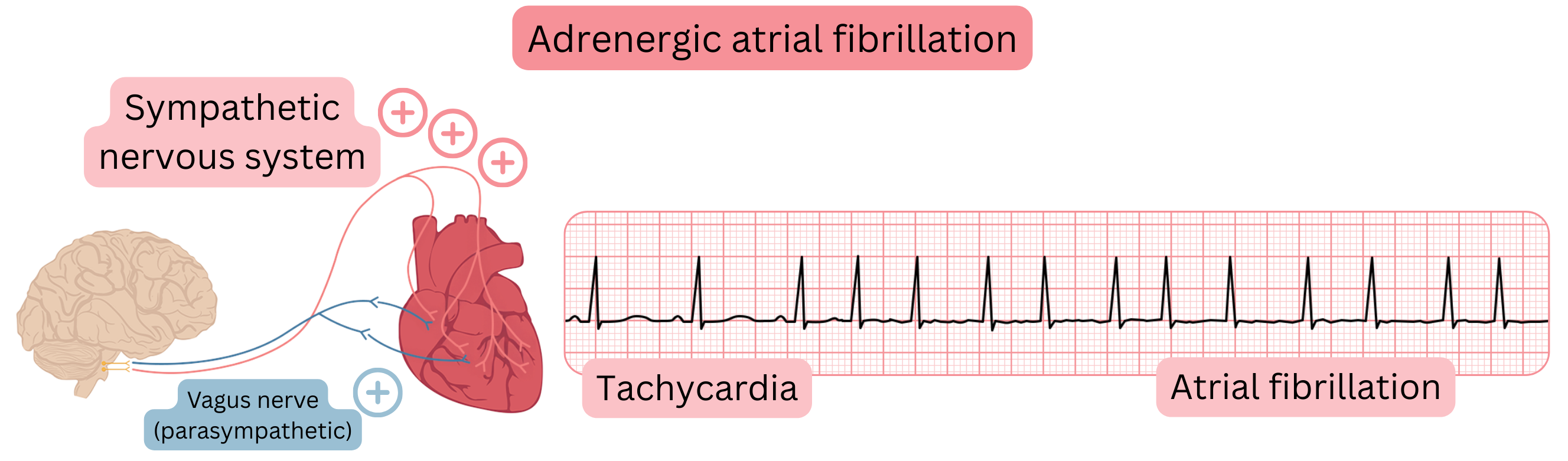 Illustration depicting adrenergic atrial fibrillation mediated by increased sympathetic activity with tachycardia and transition to atrial fibrillation on ECG recording.