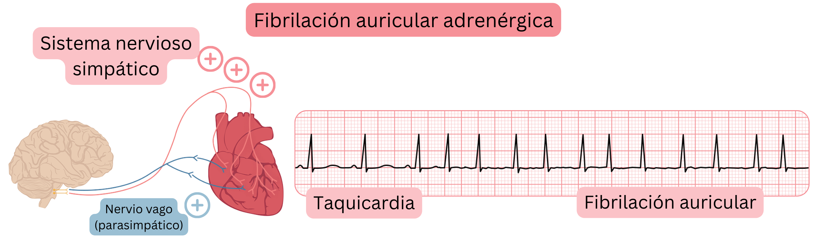 Ilustración que muestra la fibrilación auricular adrenérgica mediada por un aumento de la actividad simpática, con taquicardia y transición a fibrilación auricular en el registro ECG.
