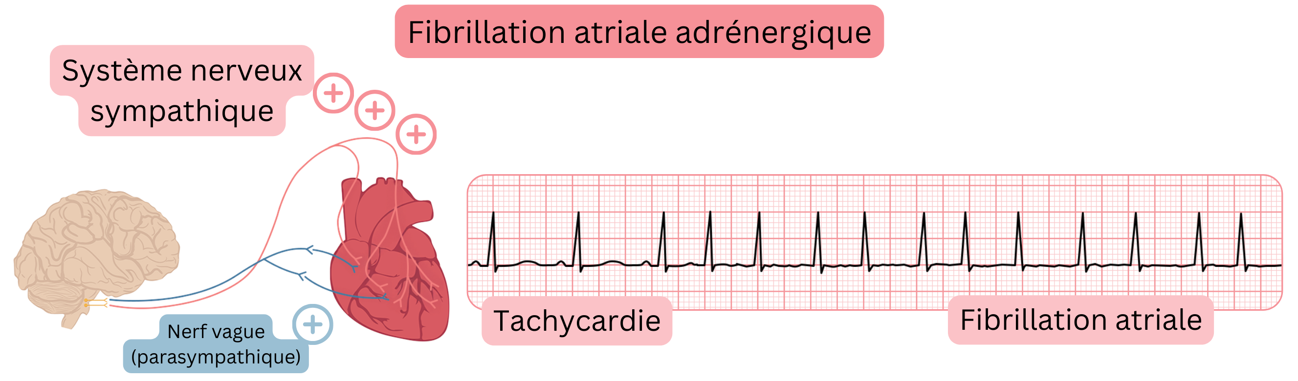 Illustration représentant la fibrillation atriale adrénergique médiée par une augmentation de l’activité sympathique, avec tachycardie et transition vers la fibrillation atriale sur le tracé ECG.
