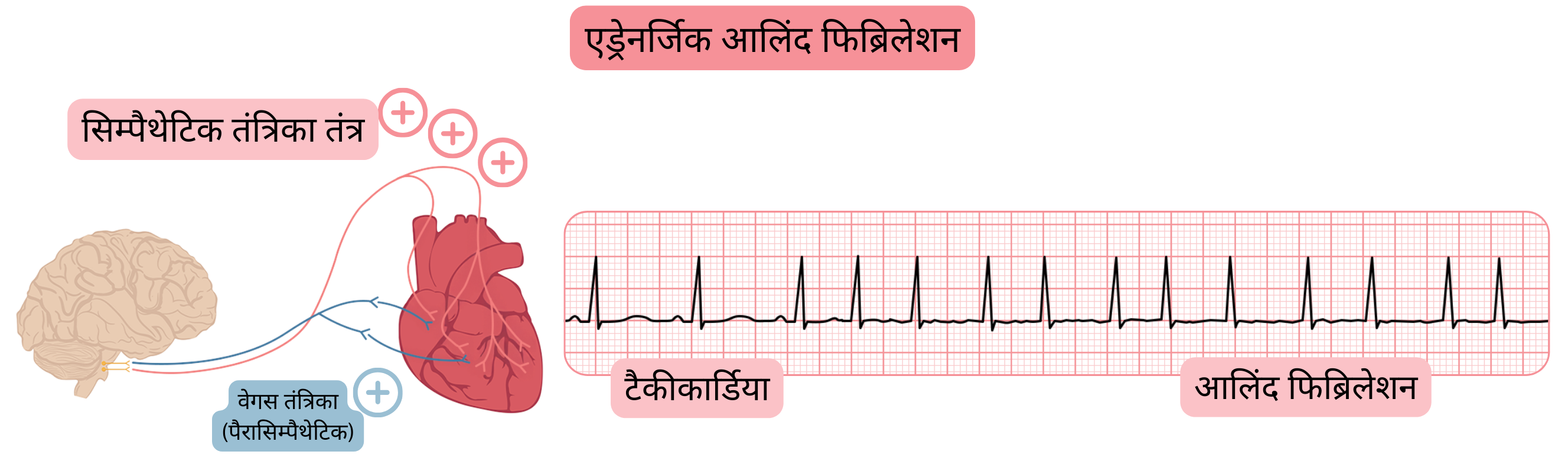 चित्र में बढ़ी हुई सिम्पैथेटिक गतिविधि द्वारा मध्यस्थित एड्रेनर्जिक एट्रियल फिब्रिलेशन को दर्शाया गया है, जिसमें टैकीकार्डिया और ईसीजी पर एट्रियल फिब्रिलेशन में परिवर्तन दिखाया गया है।