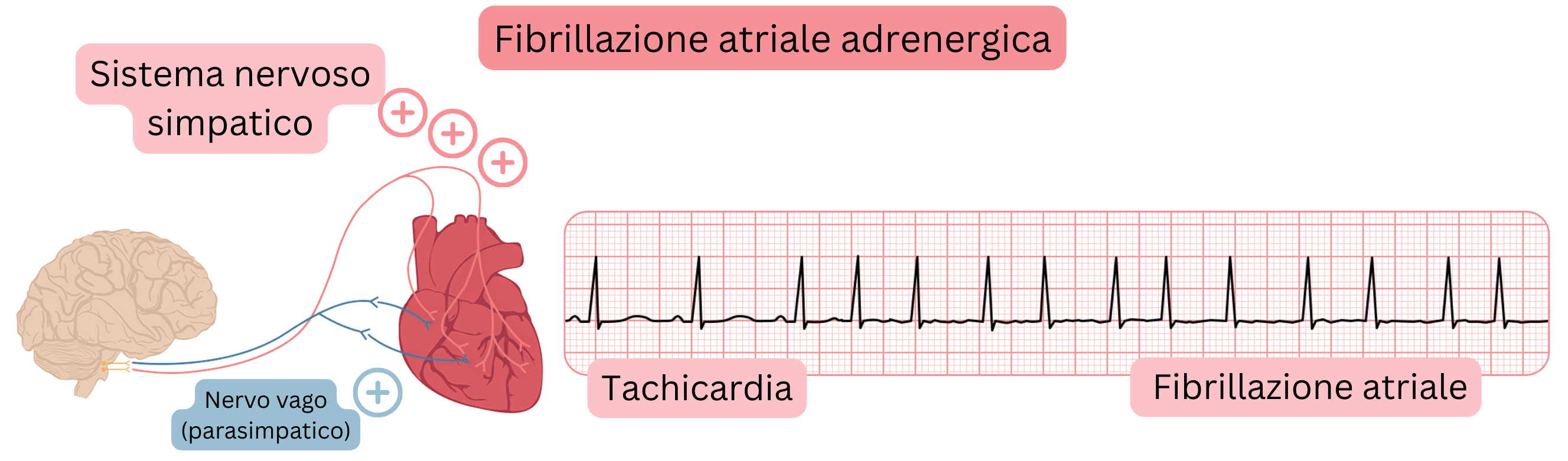 Illustrazione che mostra la fibrillazione atriale adrenergica mediata dall’aumentata attività simpatica, con tachicardia e transizione alla fibrillazione atriale sul tracciato ECG.