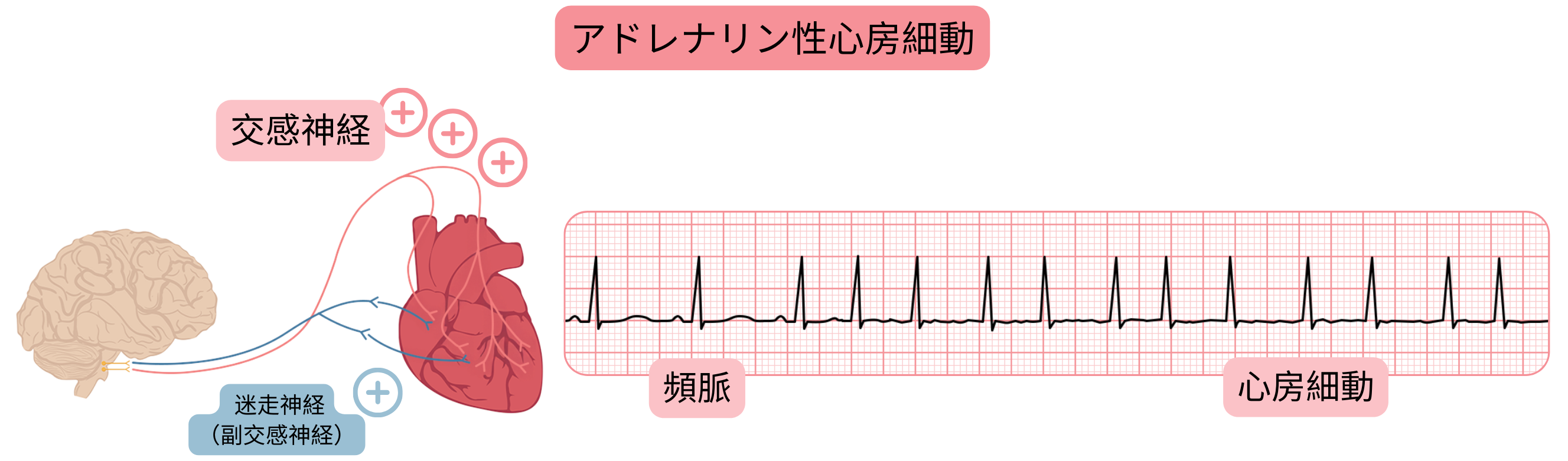 交感神経活動の亢進により生じるアドレナリン作動性心房細動を示し、頻脈から心房細動への移行を心電図で示した図。