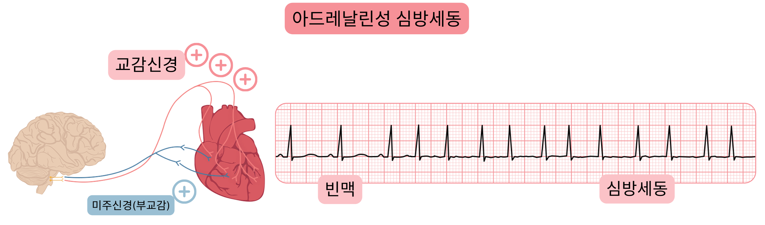 교감신경 활성 증가로 매개되는 아드레날린성 심방세동을 보여주며, 빈맥과 심전도에서 심방세동으로의 전환을 나타낸 일러스트.