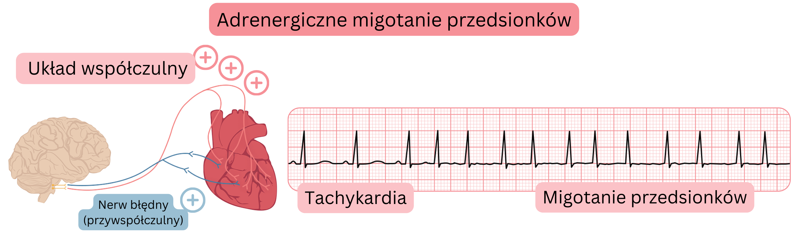 Ilustracja przedstawiająca adrenergiczne migotanie przedsionków wywołane zwiększoną aktywnością układu współczulnego, z tachykardią i przejściem do migotania przedsionków w zapisie EKG.