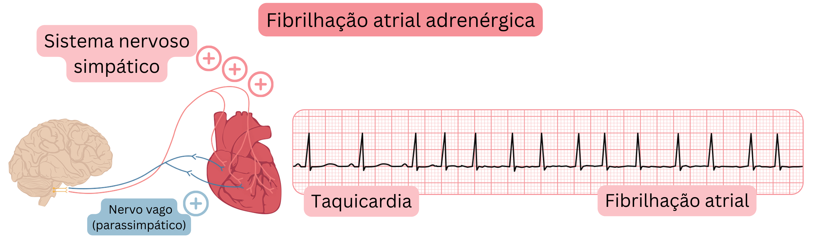 Ilustração que demonstra a fibrilação atrial adrenérgica mediada pelo aumento da atividade simpática, com taquicardia e transição para fibrilação atrial no registo ECG.