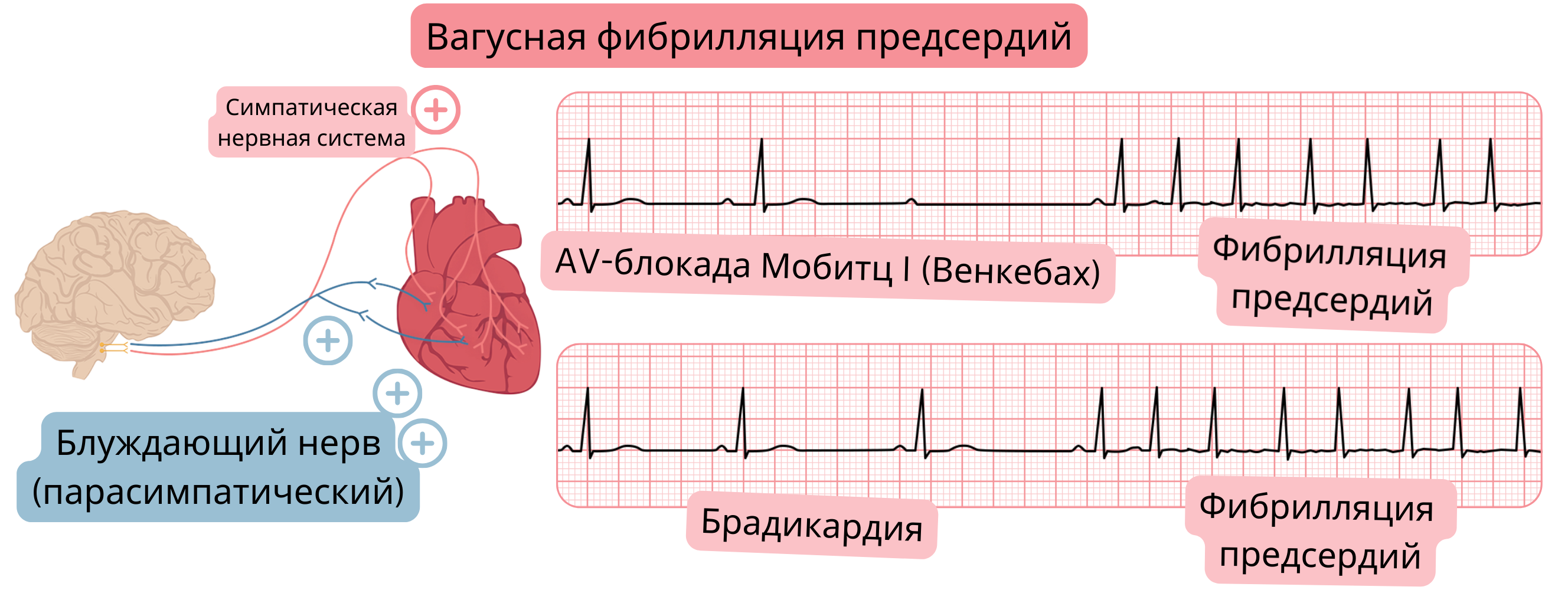 Иллюстрация, демонстрирующая адренергическую фибрилляцию предсердий, обусловленную повышенной симпатической активностью, с тахикардией и переходом в фибрилляцию предсердий на ЭКГ.