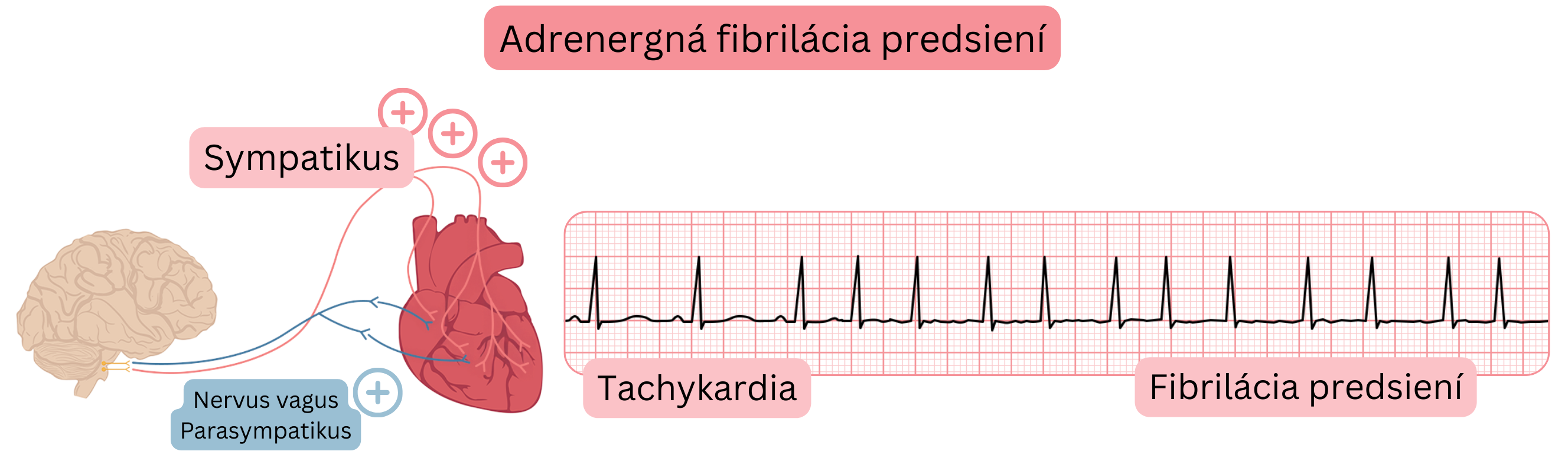 Ilustrácia znázorňujúca adrenergickú fibriláciu predsiení sprostredkovanú zvýšenou aktivitou sympatika s tachykardiou a prechodom do fibrilácie predsiení na EKG zázname.
