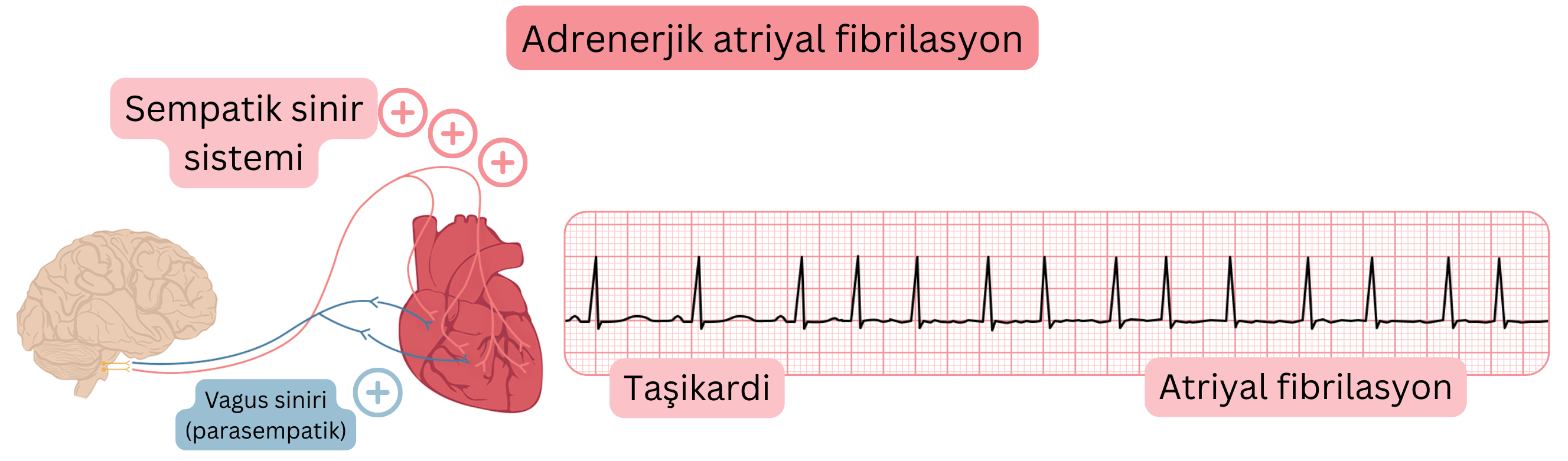 Artmış sempatik aktivite ile ilişkili adrenerjik atriyal fibrilasyonu, taşikardi ve EKG kaydında atriyal fibrilasyona geçiş ile gösteren illüstrasyon.