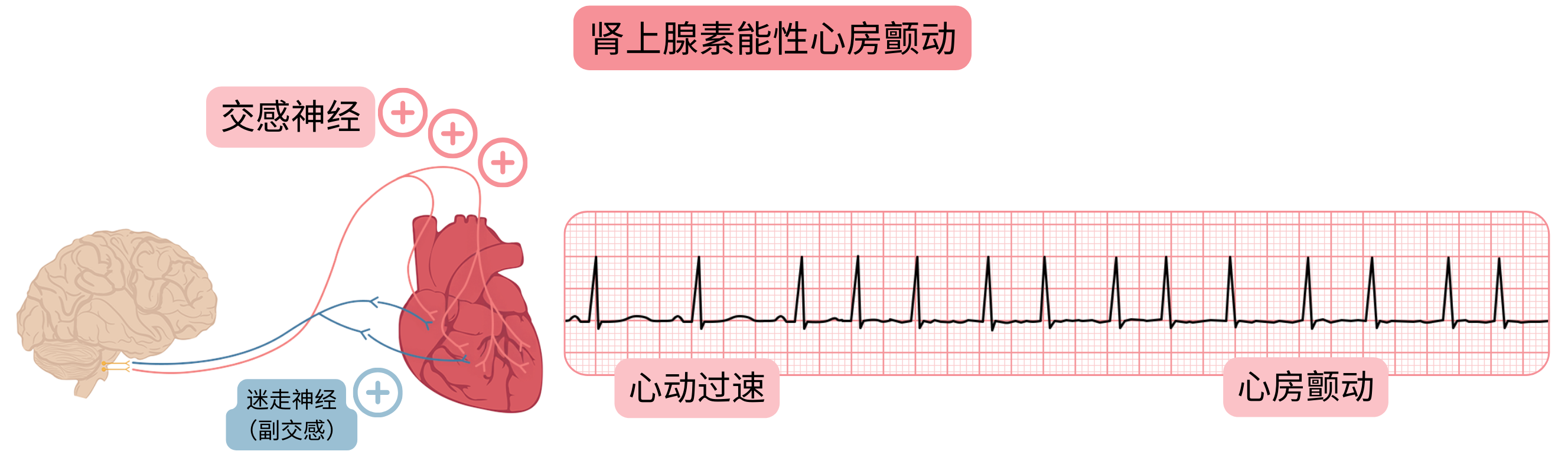 示意图展示由交感神经活动增强介导的肾上腺素能性心房颤动，伴随心动过速并在心电图上转变为心房颤动。