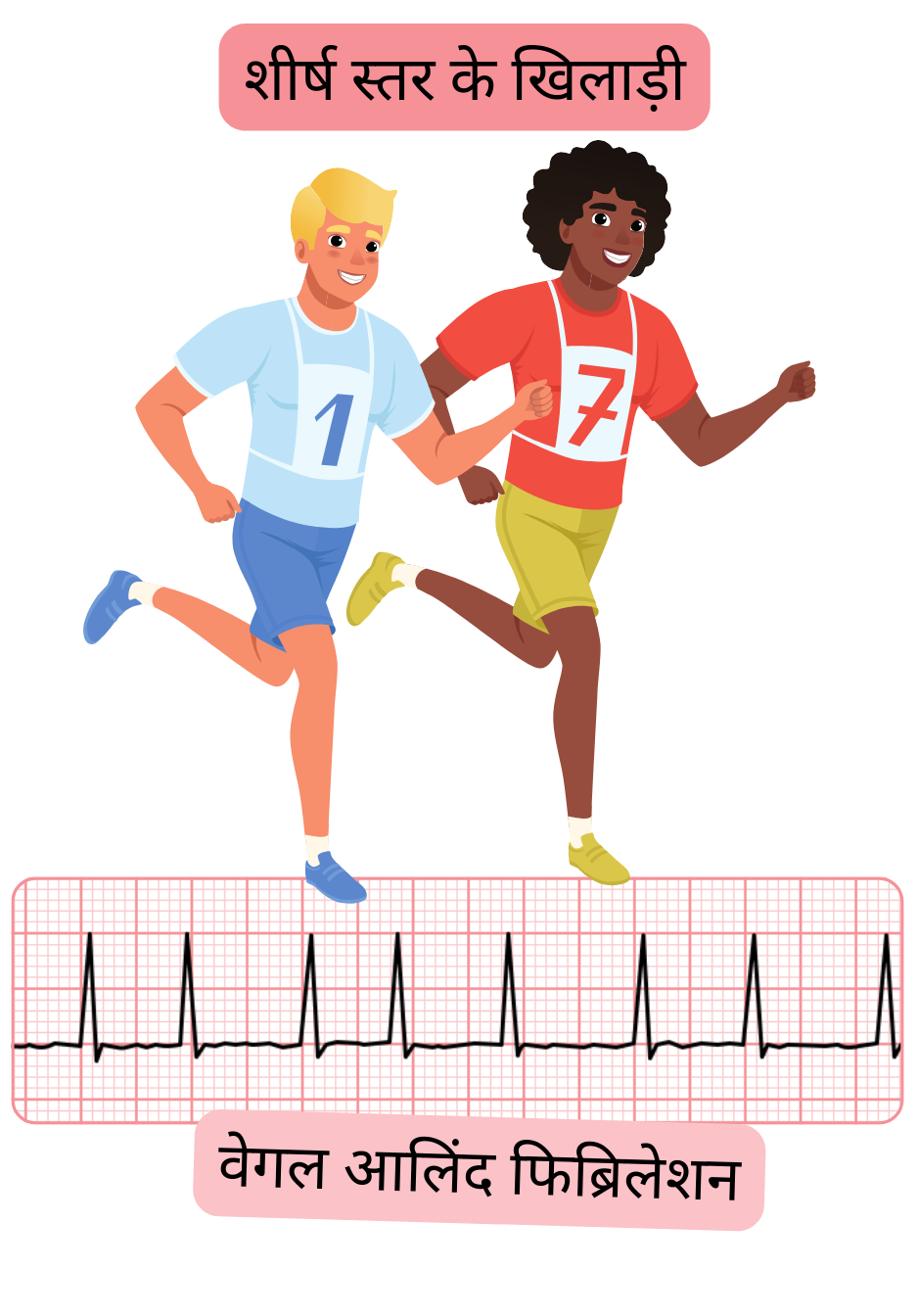 चित्र में शीर्ष स्तर के एथलीटों में वागल-नियंत्रित एट्रियल फिब्रिलेशन को दर्शाया गया है, जो बढ़े हुए पैरासिम्पेथेटिक टोन से जुड़ी अतालता का एक रूप है, साथ में प्रलेखित ईसीजी रिकॉर्ड।