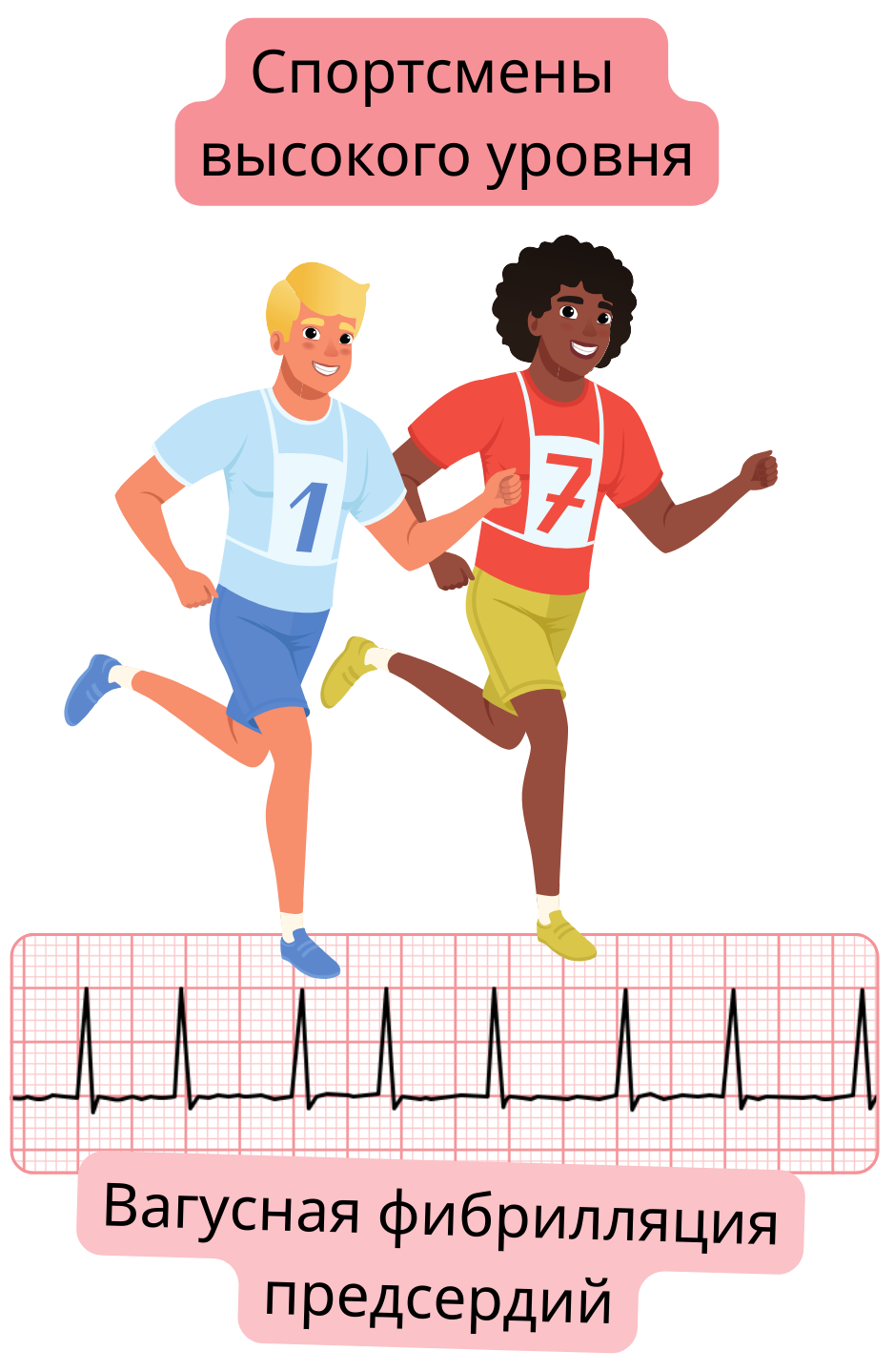 Иллюстрация, показывающая спортсменов высокого уровня с вагус-опосредованной фибрилляцией предсердий как формой аритмии, связанной с повышенным парасимпатическим тонусом, с документированной ЭКГ-записью.