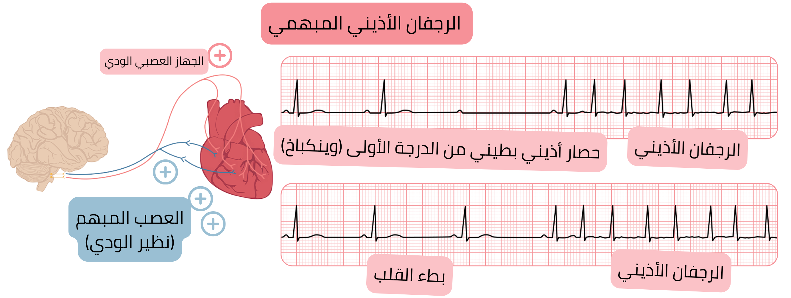 رسم توضيحي يبيّن الرجفان الأذيني المبهمي الناتج عن زيادة نشاط الجهاز نظير الودي مع بطء القلب، حصار أذيني بطيني من الدرجة الأولى نوع موبتز I (وينكباخ)، والانتقال إلى الرجفان الأذيني على تخطيط القلب الكهربائي.