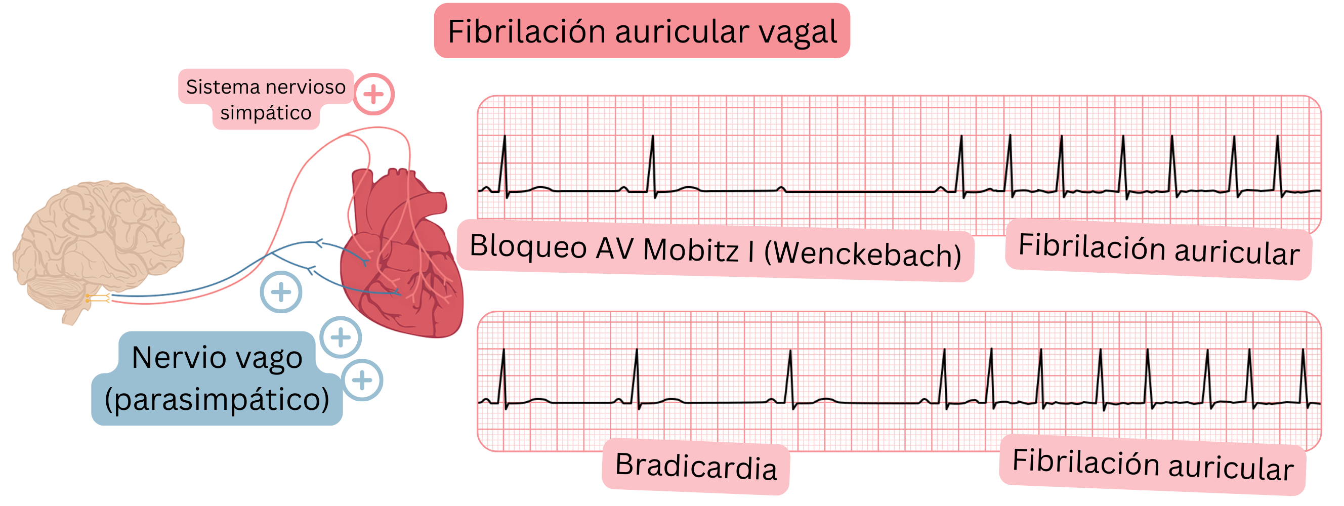 Ilustración que muestra la fibrilación auricular vagal mediada por un aumento de la actividad parasimpática, con bradicardia, bloqueo AV Mobitz I (Wenckebach) y transición a fibrilación auricular en el registro ECG.