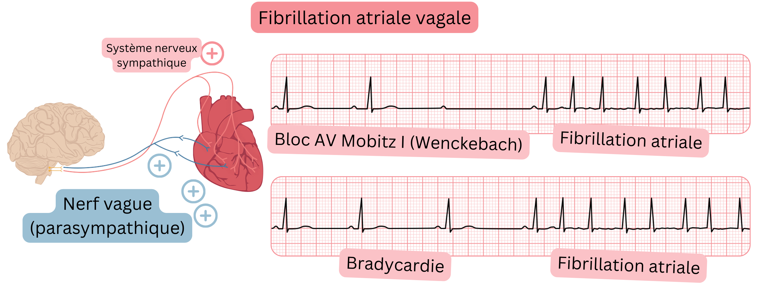 Illustration représentant la fibrillation atriale vagale liée à une augmentation du tonus parasympathique, avec bradycardie, bloc AV de type Mobitz I (Wenckebach) et transition vers la fibrillation atriale sur le tracé ECG.