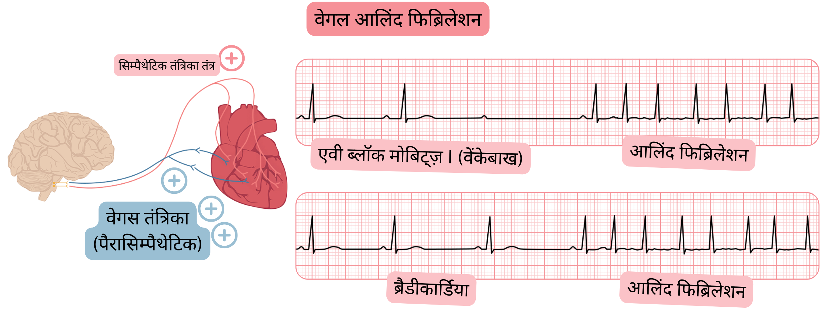 चित्र में बढ़ी हुई पैरासिम्पेथेटिक गतिविधि से उत्पन्न वागल एट्रियल फिब्रिलेशन को दर्शाया गया है, जिसमें ब्रैडीकार्डिया, मोबिट्ज़ I (वेनकेबाख) एवी ब्लॉक और ईसीजी पर एट्रियल फिब्रिलेशन में परिवर्तन शामिल है।