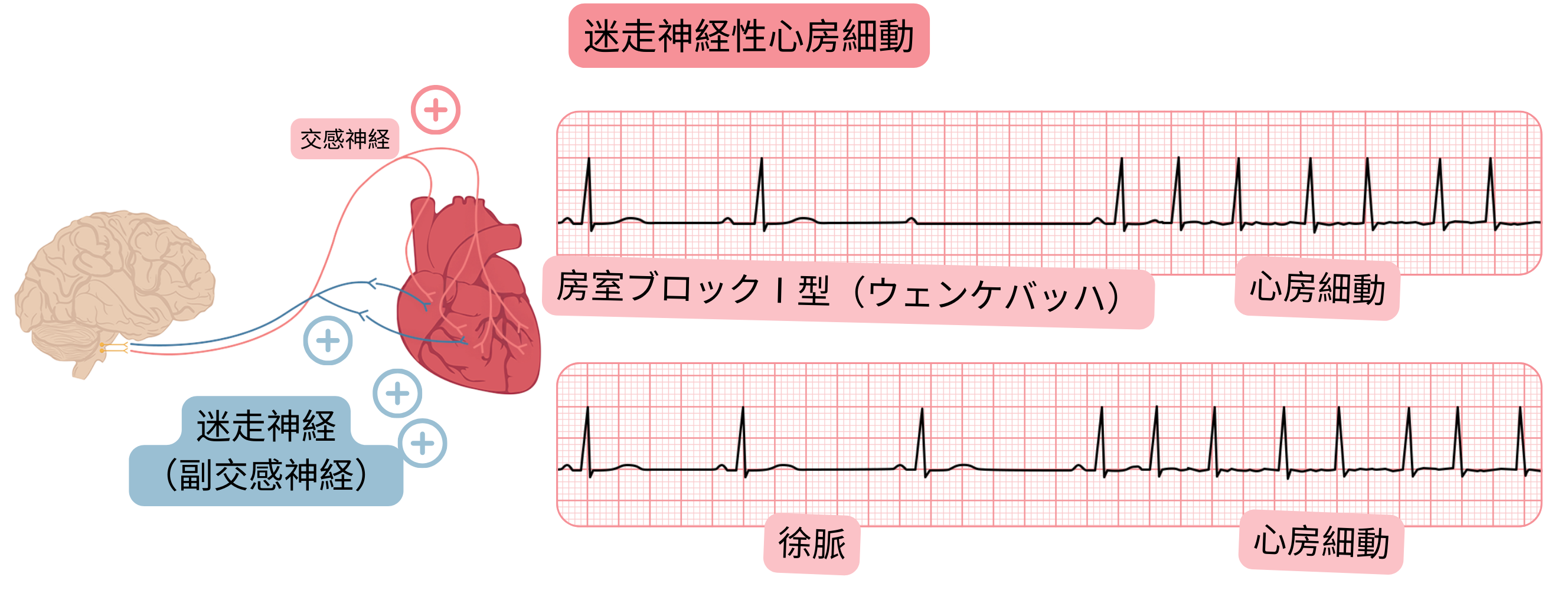 副交感神経活動の亢進により生じる迷走神経性心房細動を示し、徐脈、Mobitz I型（ウェンケバッハ）房室ブロックおよび心電図上での心房細動への移行を含む図。
