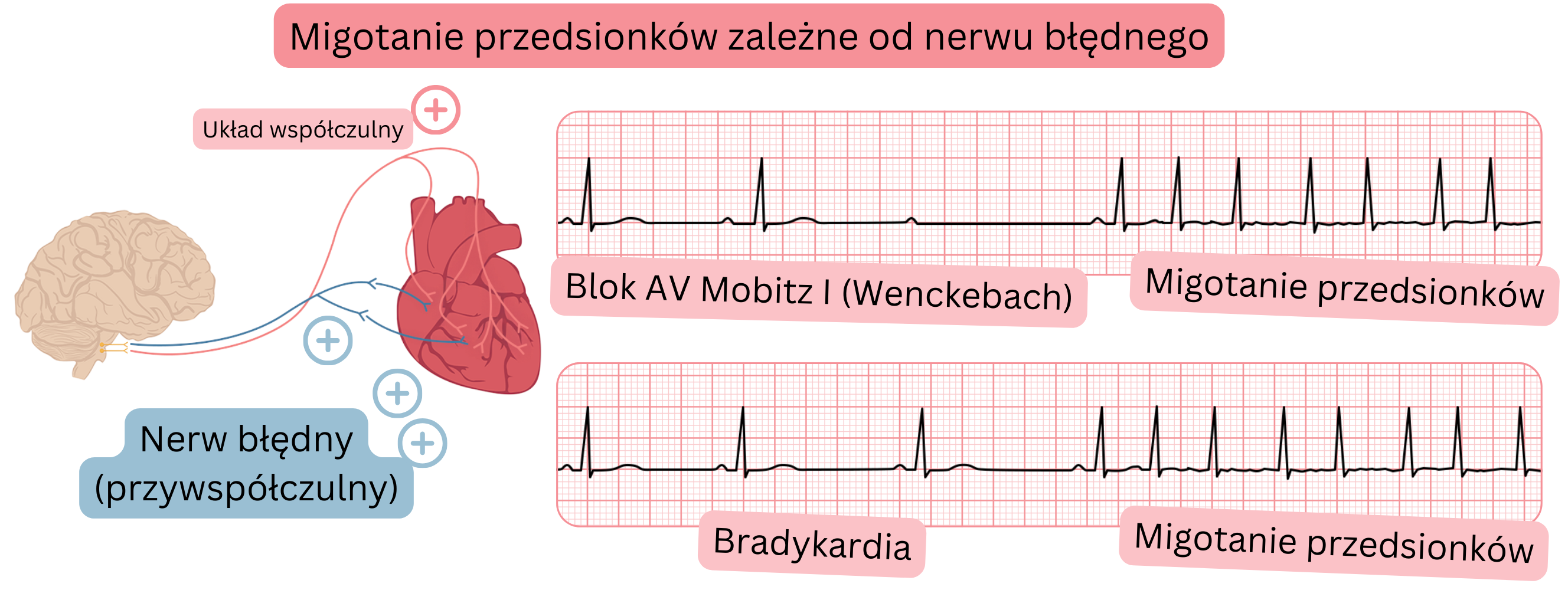 Ilustracja przedstawiająca wagotoniczne migotanie przedsionków spowodowane zwiększoną aktywnością przywspółczulną, z bradykardią, blokiem przedsionkowo-komorowym typu Mobitz I (Wenckebach) oraz przejściem do migotania przedsionków w zapisie EKG.