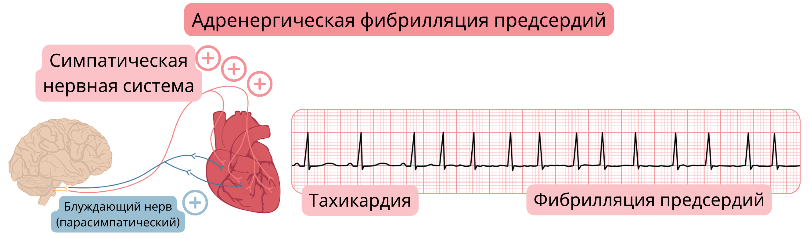 Иллюстрация, демонстрирующая вагус-опосредованную фибрилляцию предсердий вследствие повышенной парасимпатической активности с брадикардией, АВ-блокадой типа Мобитц I (Венкебах) и переходом в фибрилляцию предсердий на ЭКГ.