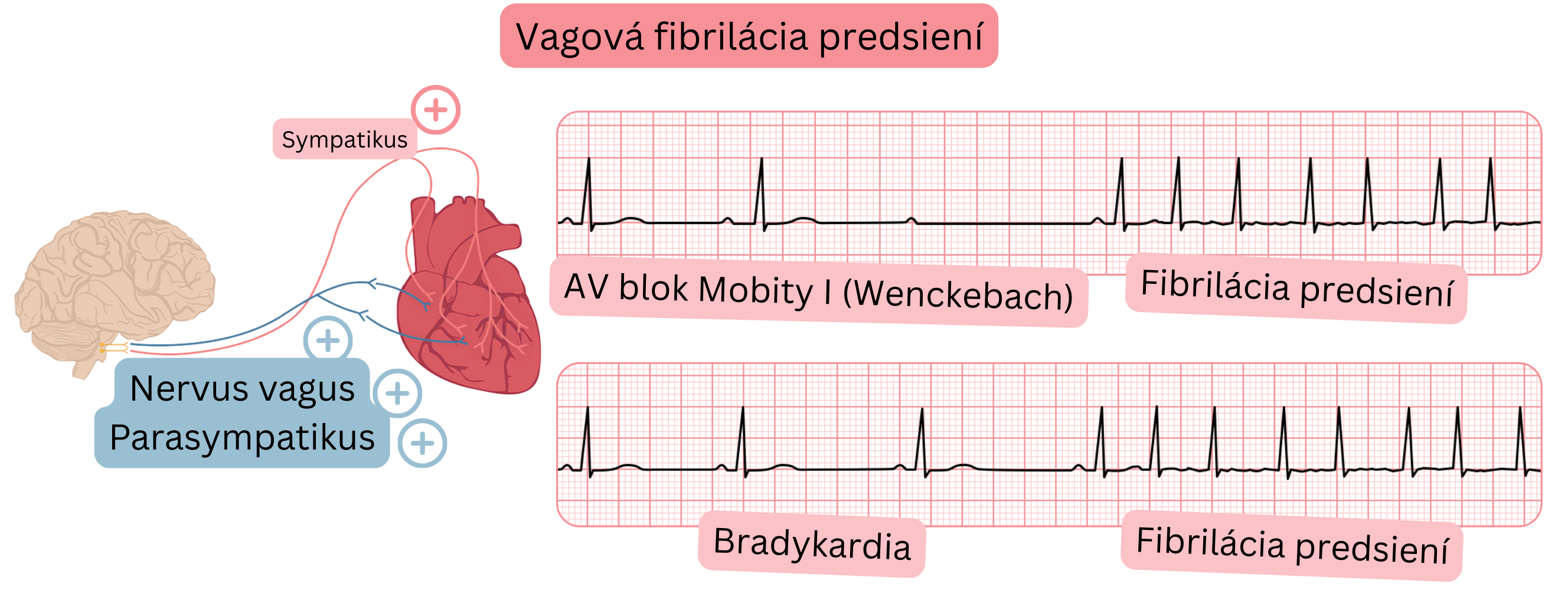 Ilustrácia znázorňujúca vagovú fibriláciu predsiení podmienenú zvýšenou aktivitou parasympatika s bradykardiou, AV blokom Mobitz I (Wenckebach) a prechodom do fibrilácie predsiení na EKG zázname.
