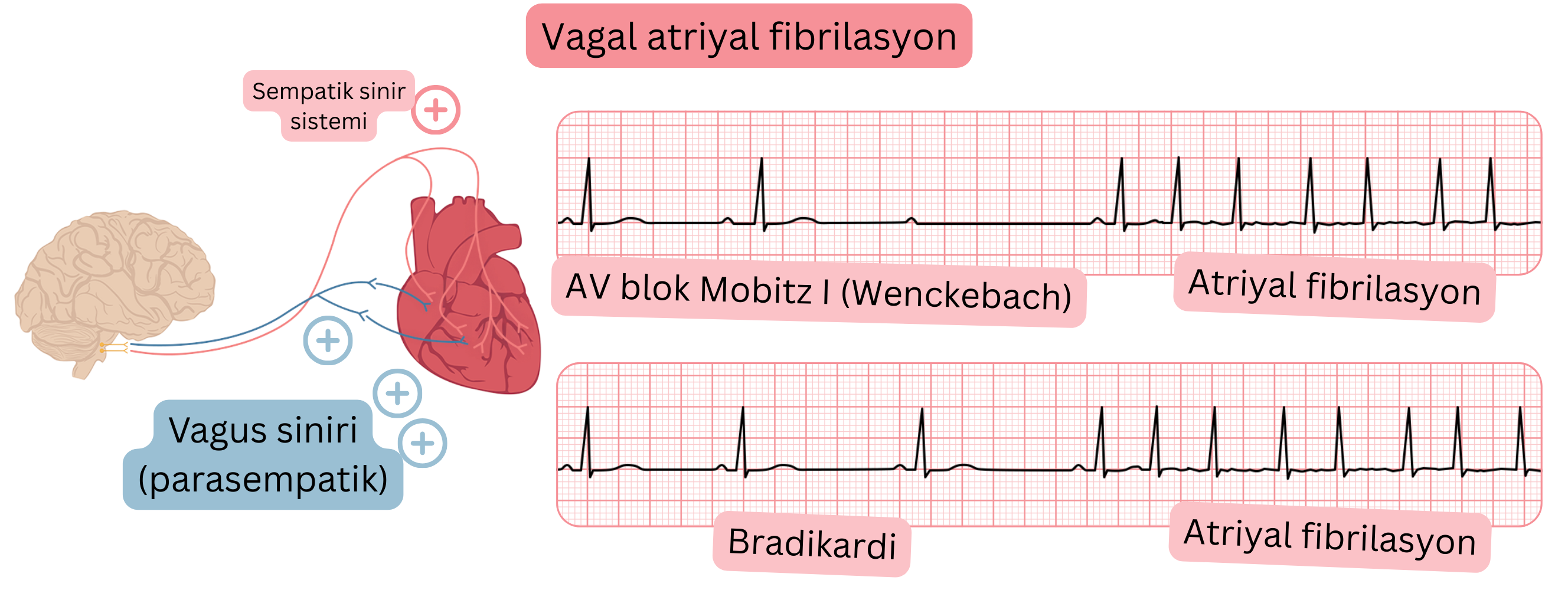 Artmış parasempatik aktiviteye bağlı vagal atriyal fibrilasyonu; bradikardi, Mobitz I (Wenckebach) AV blok ve EKG kaydında atriyal fibrilasyona geçiş ile gösteren illüstrasyon.
