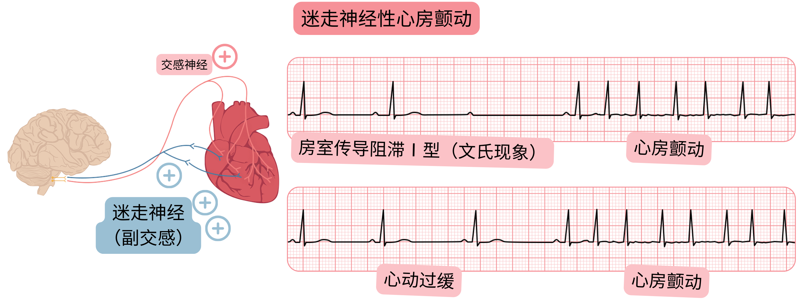 示意图展示由副交感神经活动增强介导的迷走神经性心房颤动，伴随心动过缓、Mobitz I 型（文氏型）房室传导阻滞，并在心电图上转变为心房颤动。