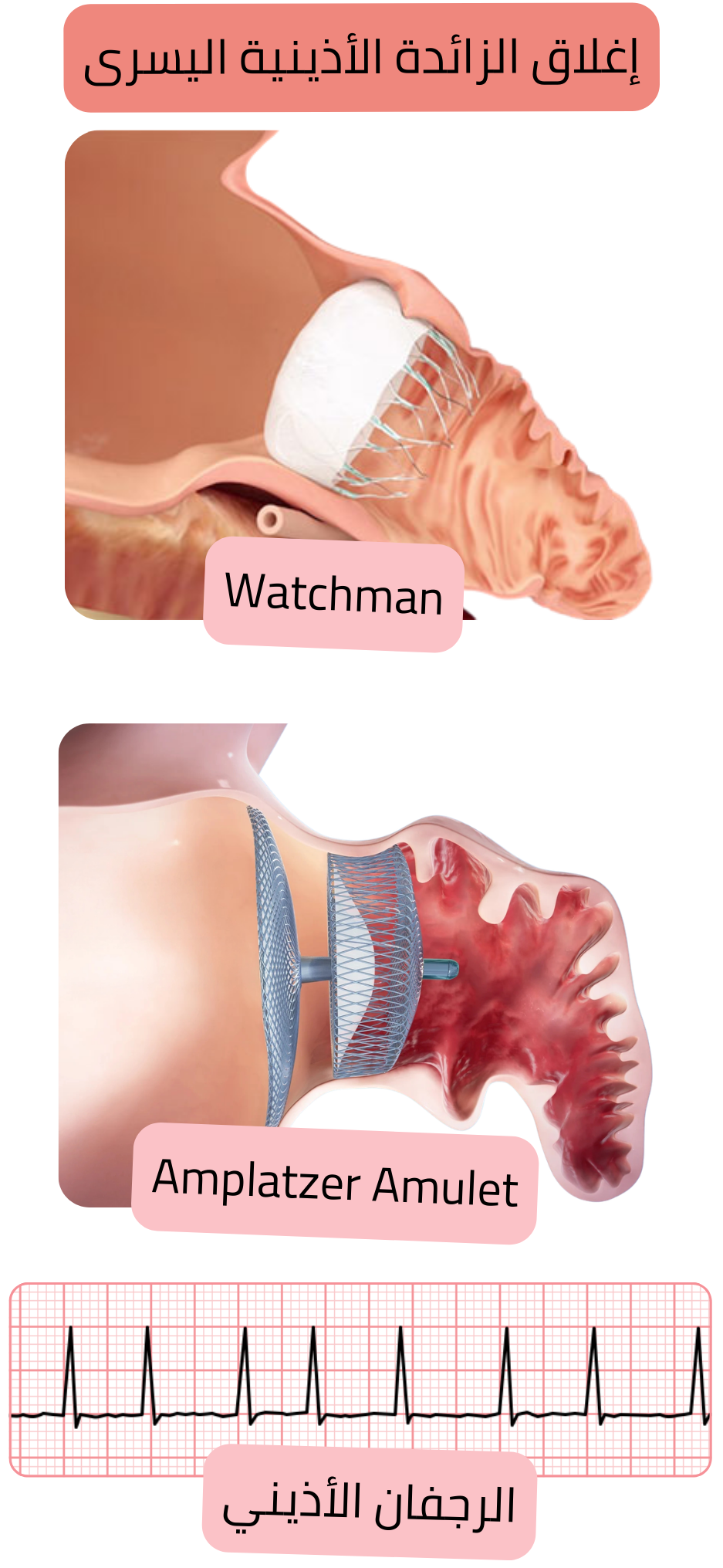 رسم توضيحي يبيّن إغلاق زائدة الأذين الأيسر باستخدام جهازي Watchman وAmplatzer Amulet كبديل للوقاية من الخثار الصمّي في الرجفان الأذيني.