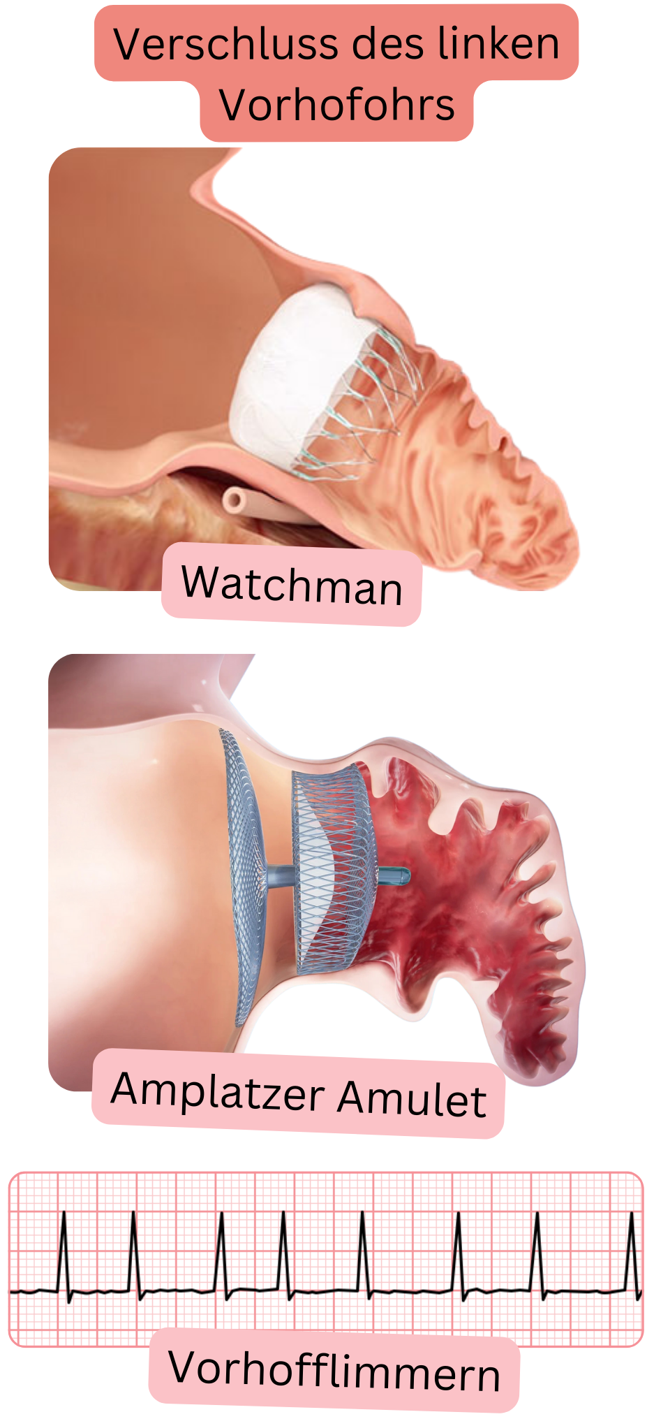 Abbildung zur Darstellung des Verschlusses des linken Vorhofohrs mit den Okklusionssystemen Watchman und Amplatzer Amulet als Alternative zur Thromboembolieprävention bei Vorhofflimmern.