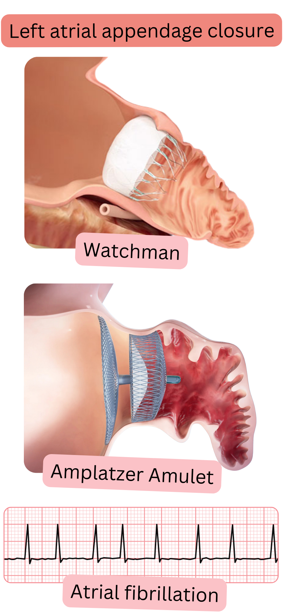 Illustration depicting left atrial appendage closure using Watchman and Amplatzer Amulet occlusion devices as an alternative strategy for thromboembolism prevention in atrial fibrillation.