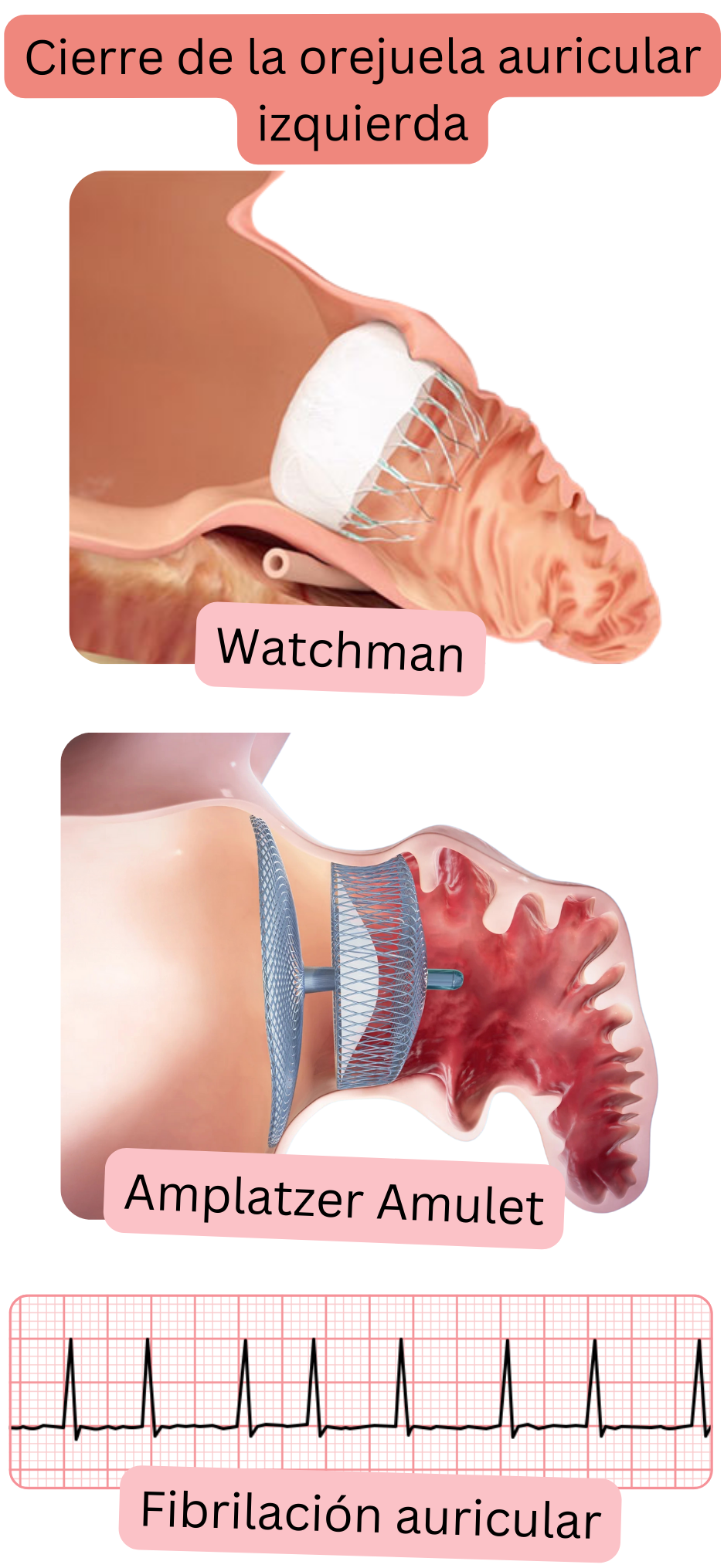 Ilustración que muestra el cierre de la orejuela auricular izquierda mediante los dispositivos oclusores Watchman y Amplatzer Amulet como alternativa para la prevención del tromboembolismo en la fibrilación auricular.