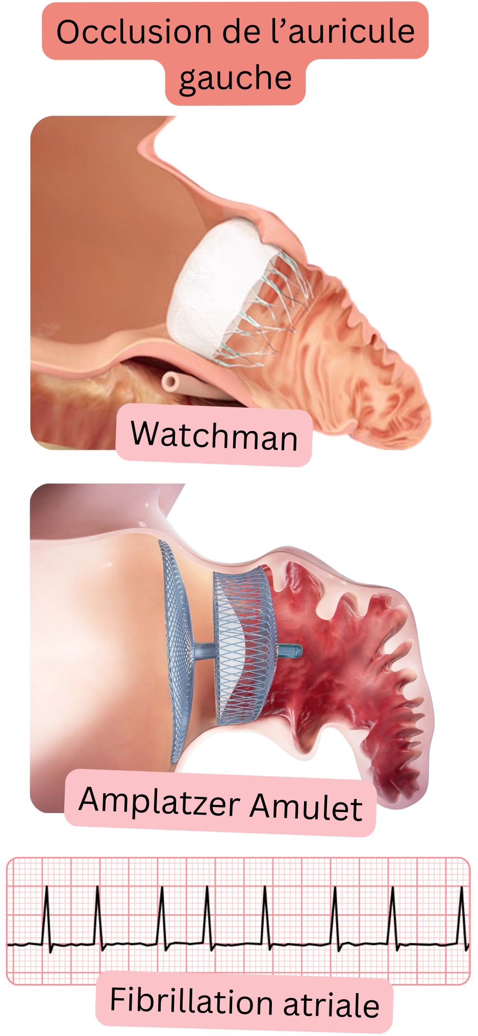 Illustration représentant l’occlusion de l’auricule gauche à l’aide des dispositifs Watchman et Amplatzer Amulet comme alternative à la prévention du thromboembolisme chez les patients atteints de fibrillation atriale.