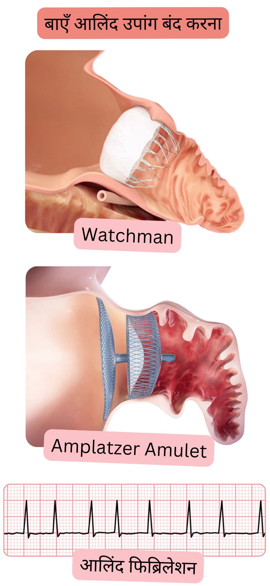 चित्र में Watchman और Amplatzer Amulet अवरोधक उपकरणों का उपयोग करके बाएँ एट्रियल एपेंडेज क्लोज़र को एट्रियल फिब्रिलेशन में थ्रोम्बोएम्बोलिज़्म की रोकथाम के वैकल्पिक उपाय के रूप में दर्शाया गया है।