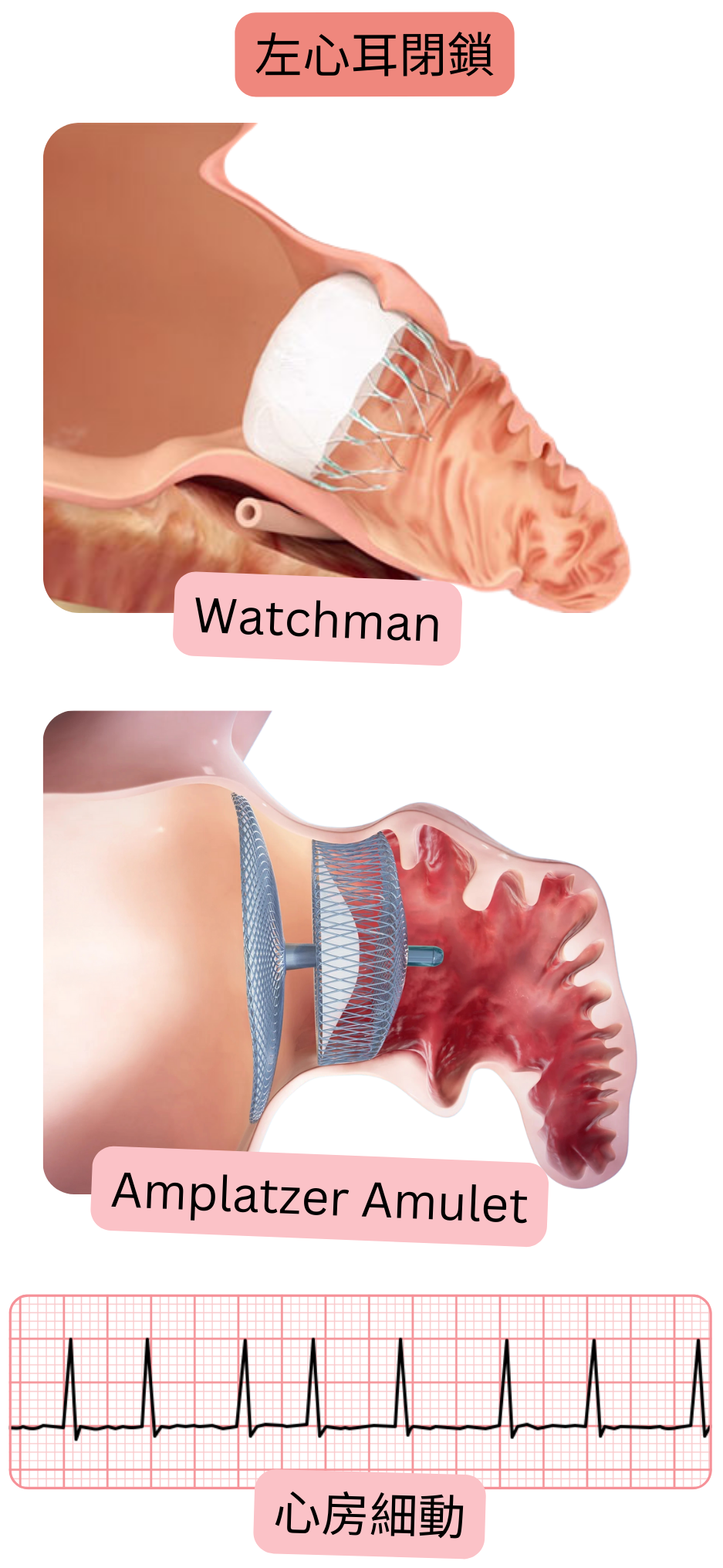 心房細動における血栓塞栓症予防の代替手段として、WatchmanおよびAmplatzer Amuletデバイスを用いた左心耳閉鎖を示す図。