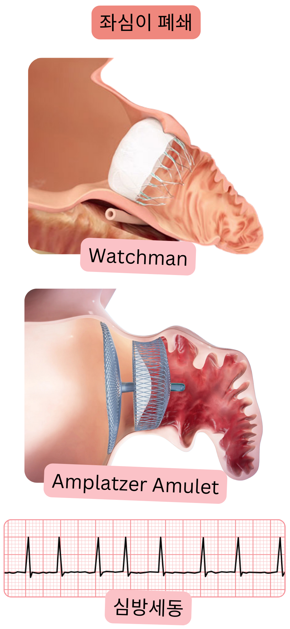 심방세동에서 혈전색전증 예방의 대안으로 Watchman 및 Amplatzer Amulet 폐쇄 장치를 이용한 좌심방이 폐쇄를 보여주는 일러스트.