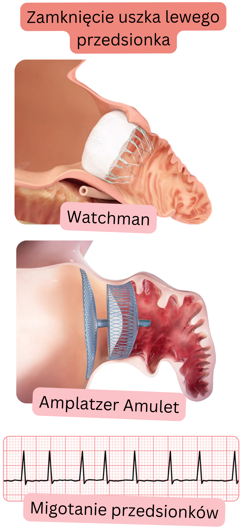 Ilustracja przedstawiająca zamknięcie uszka lewego przedsionka za pomocą urządzeń okluzyjnych Watchman i Amplatzer Amulet jako alternatywę profilaktyki powikłań zakrzepowo-zatorowych w migotaniu przedsionków.